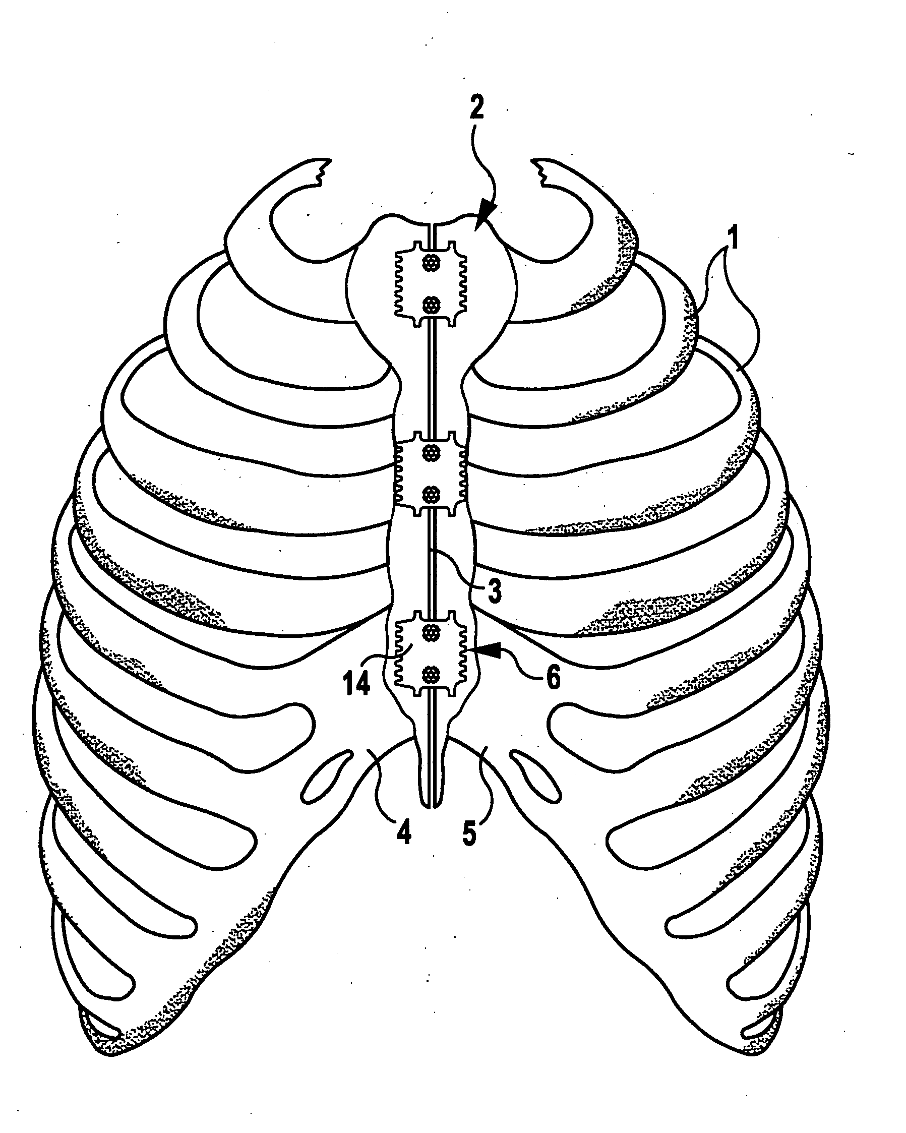 Sternum closure device