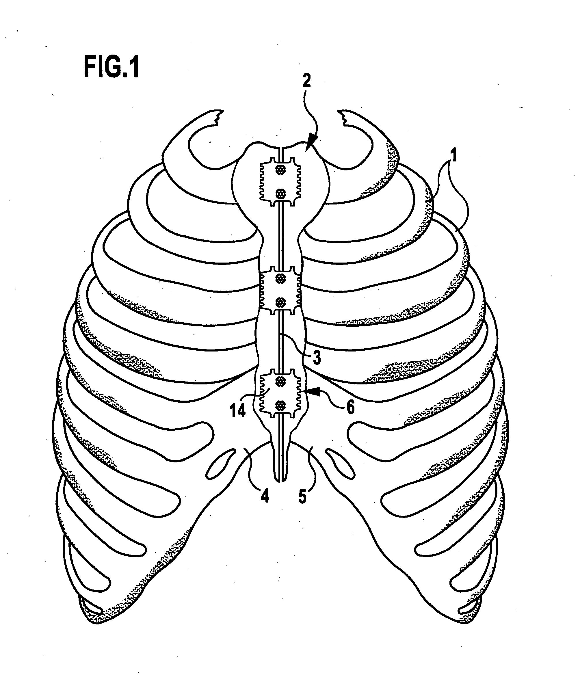 Sternum closure device