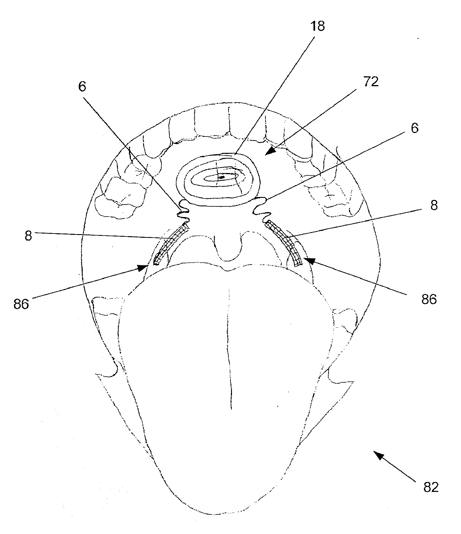 Implant for treatment of sleep disorders