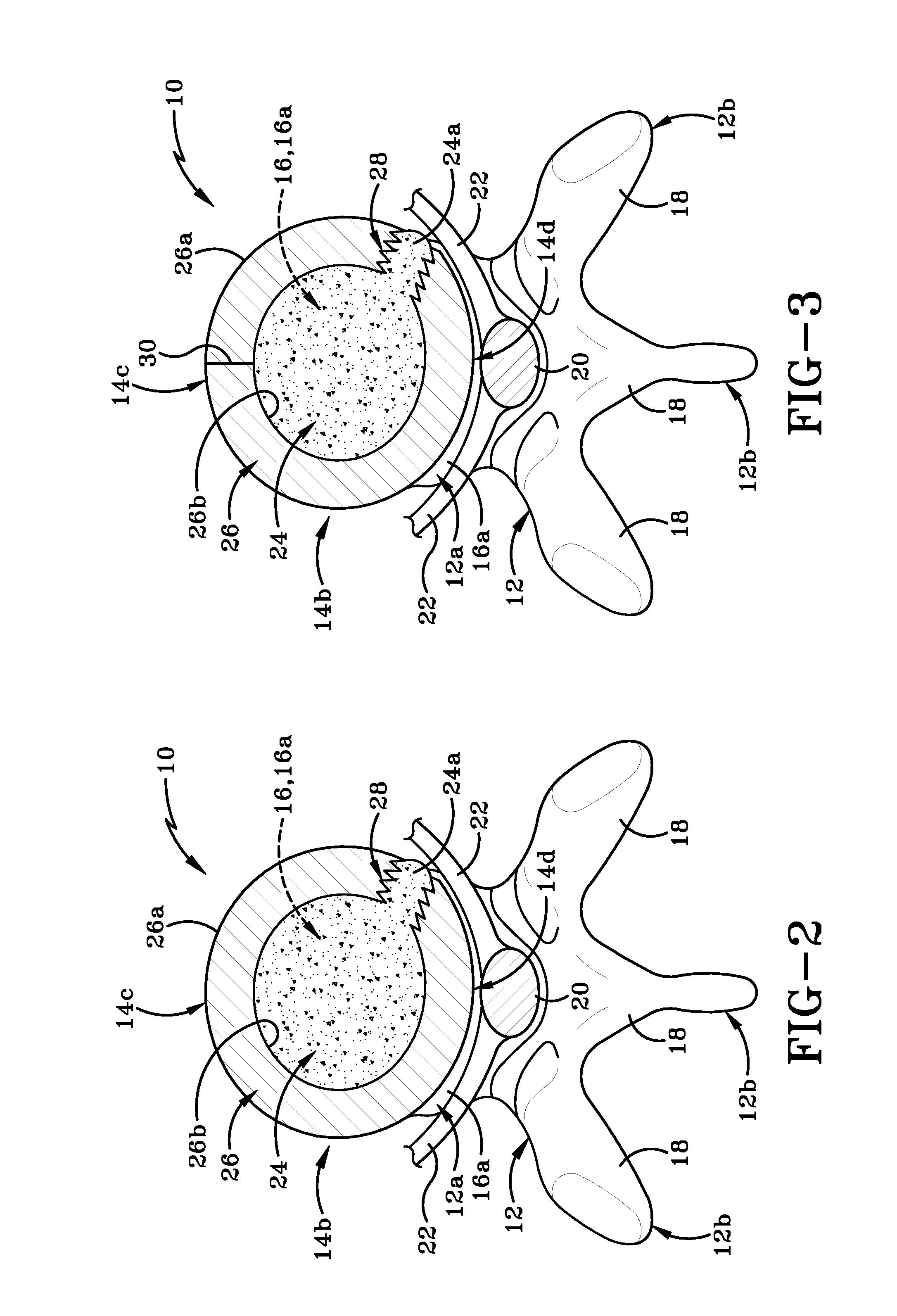 Nucleus pulposus spinal implant and method of using the same