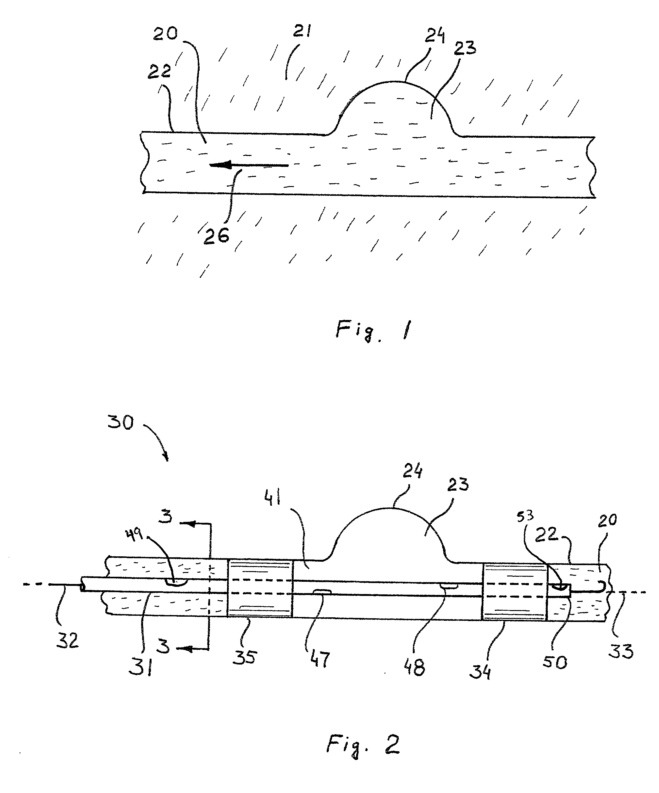 Method and apparatus for treating aneurysms