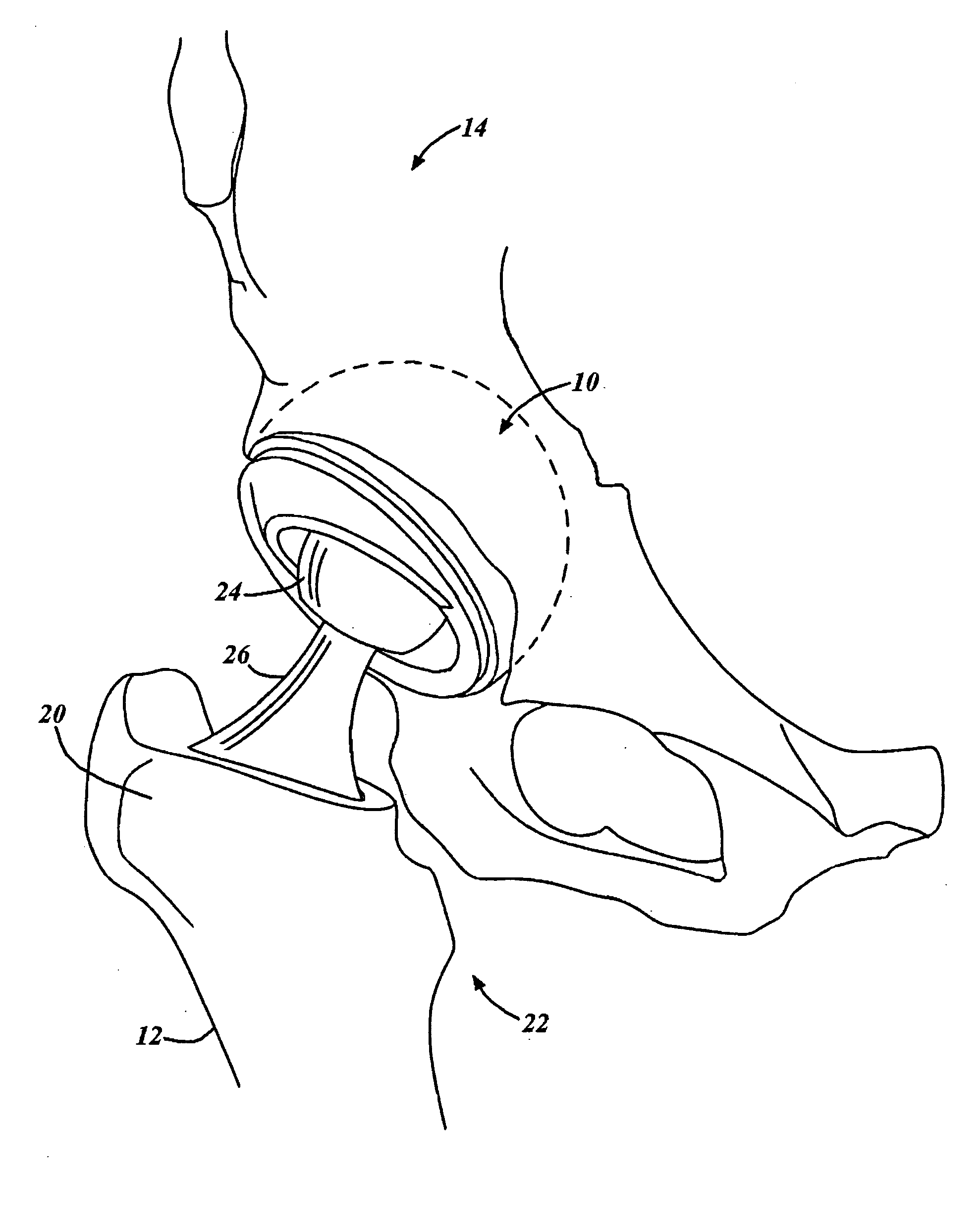 Servo-controlled impacting device for orthopedic implants