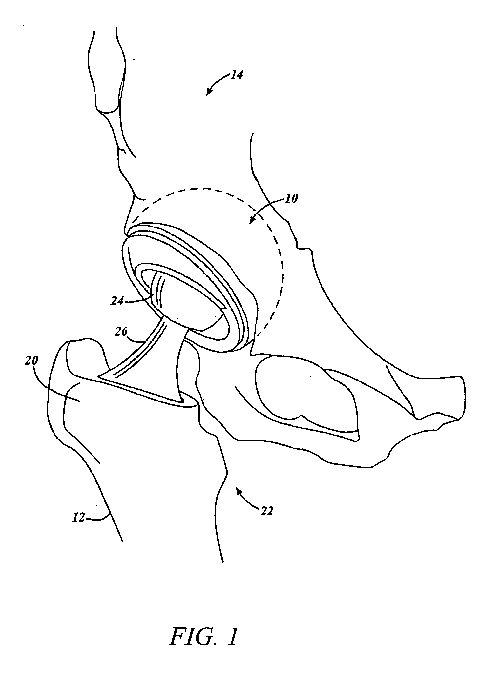 Servo-controlled impacting device for orthopedic implants