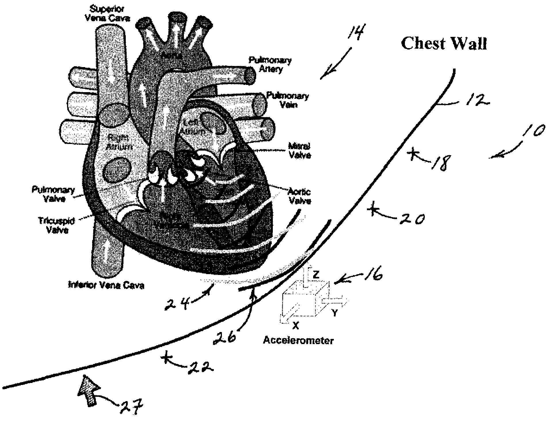 Multi-axial heart sounds and murmur detection for hemodynamic-condition assessment