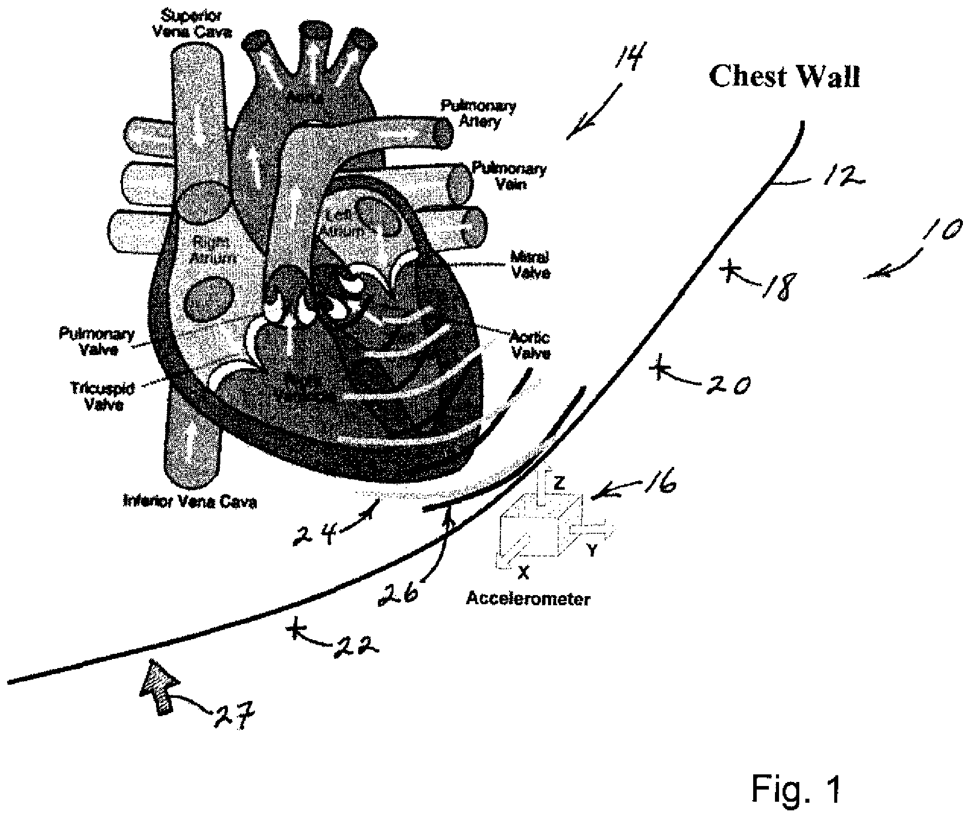 Multi-axial heart sounds and murmur detection for hemodynamic-condition assessment