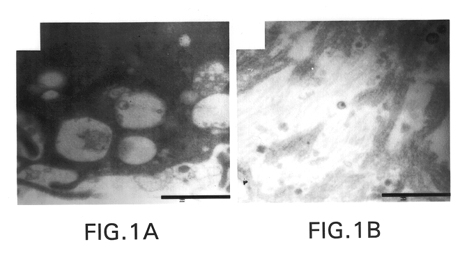 Identification of a novel retrovirus associated with primary biliary cirrhosis and autoimmune disorders