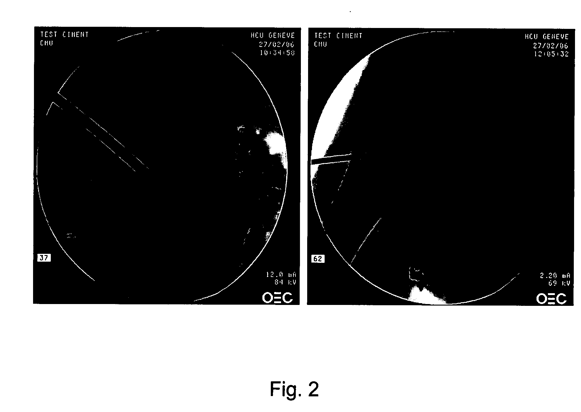 Injectable fibrin composition for bone augmentation