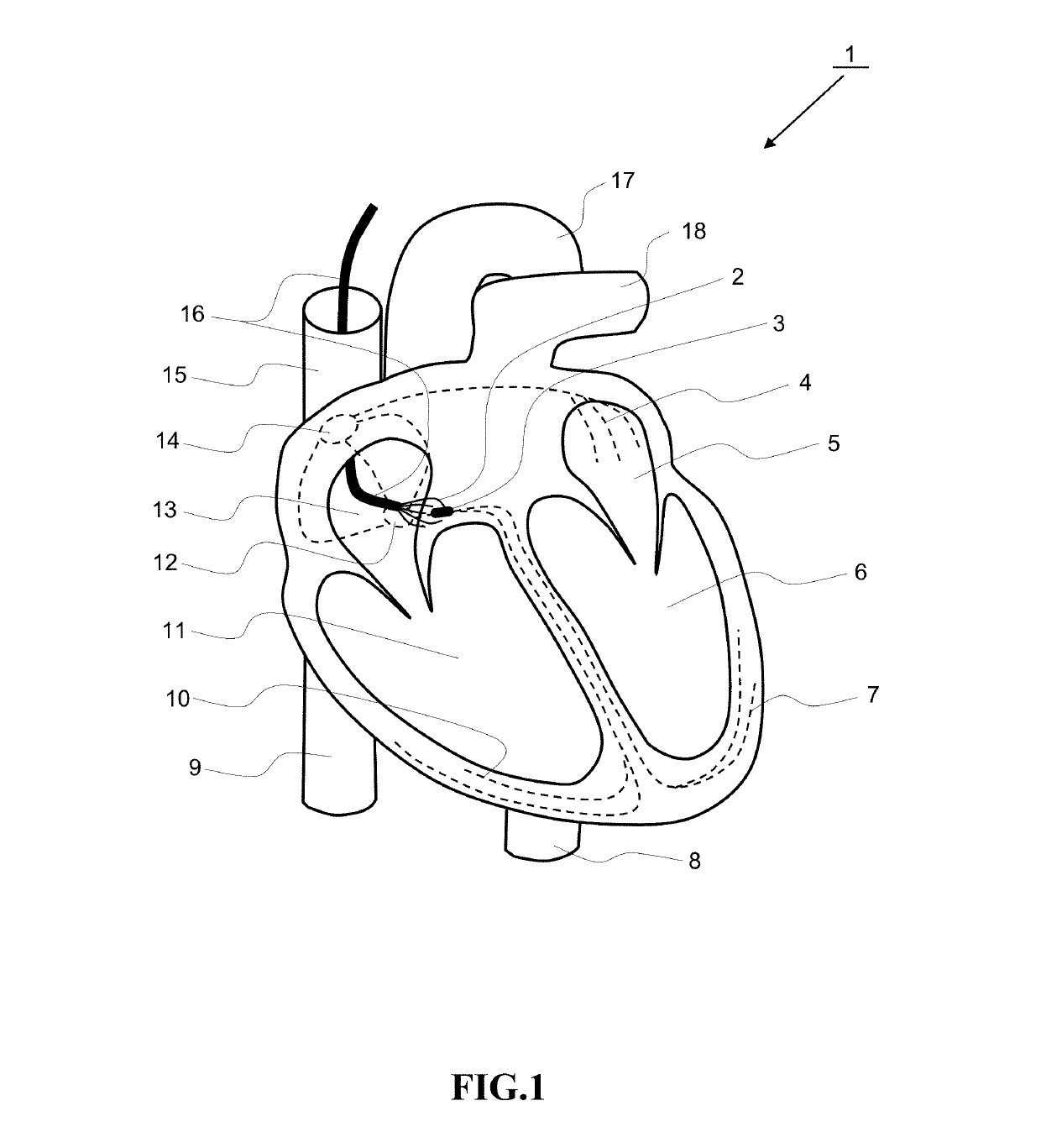 Single conduit multi-electrode cardiac pacemaker and methods of using thereof