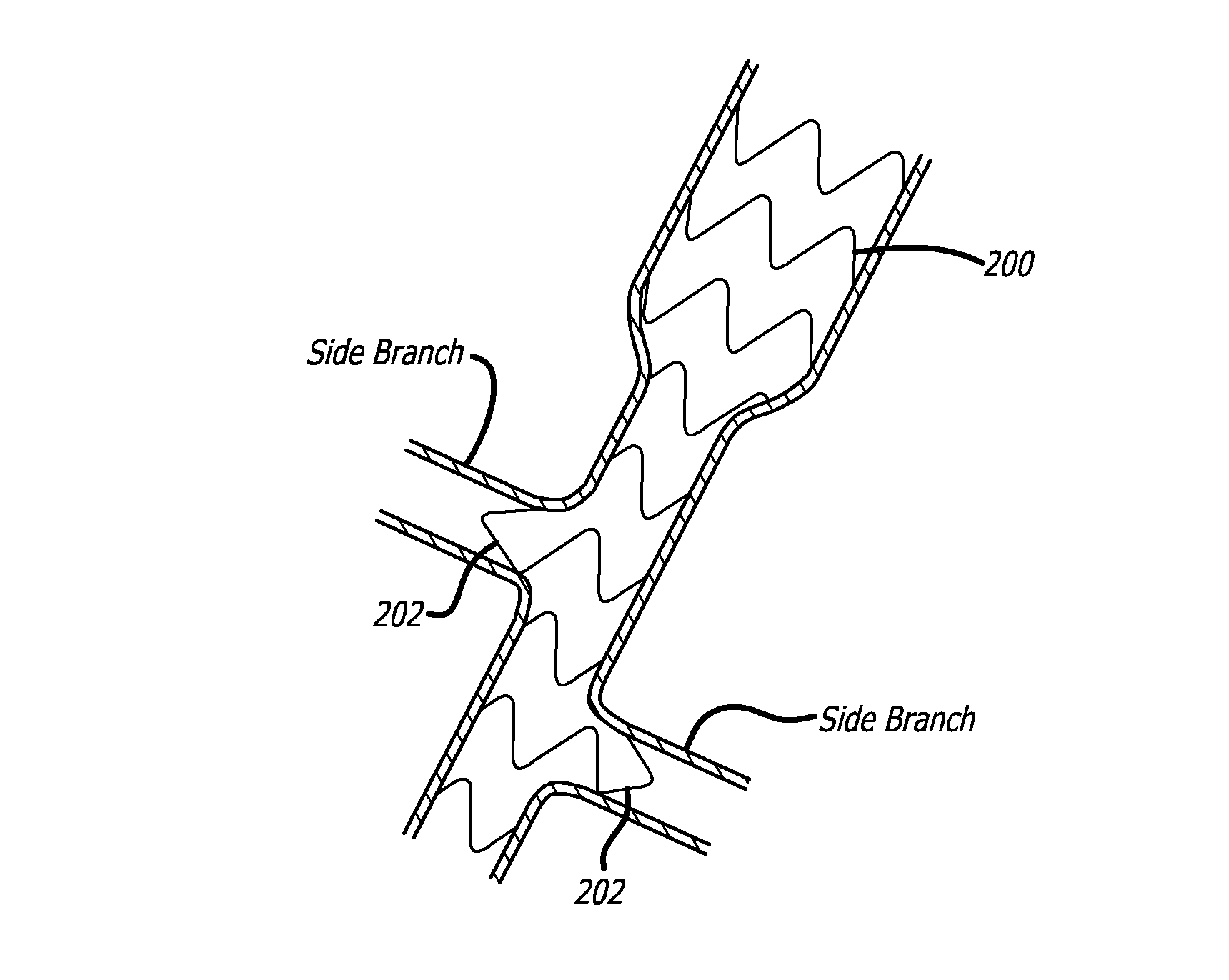 Intraluminal scaffold having an enlarged portion