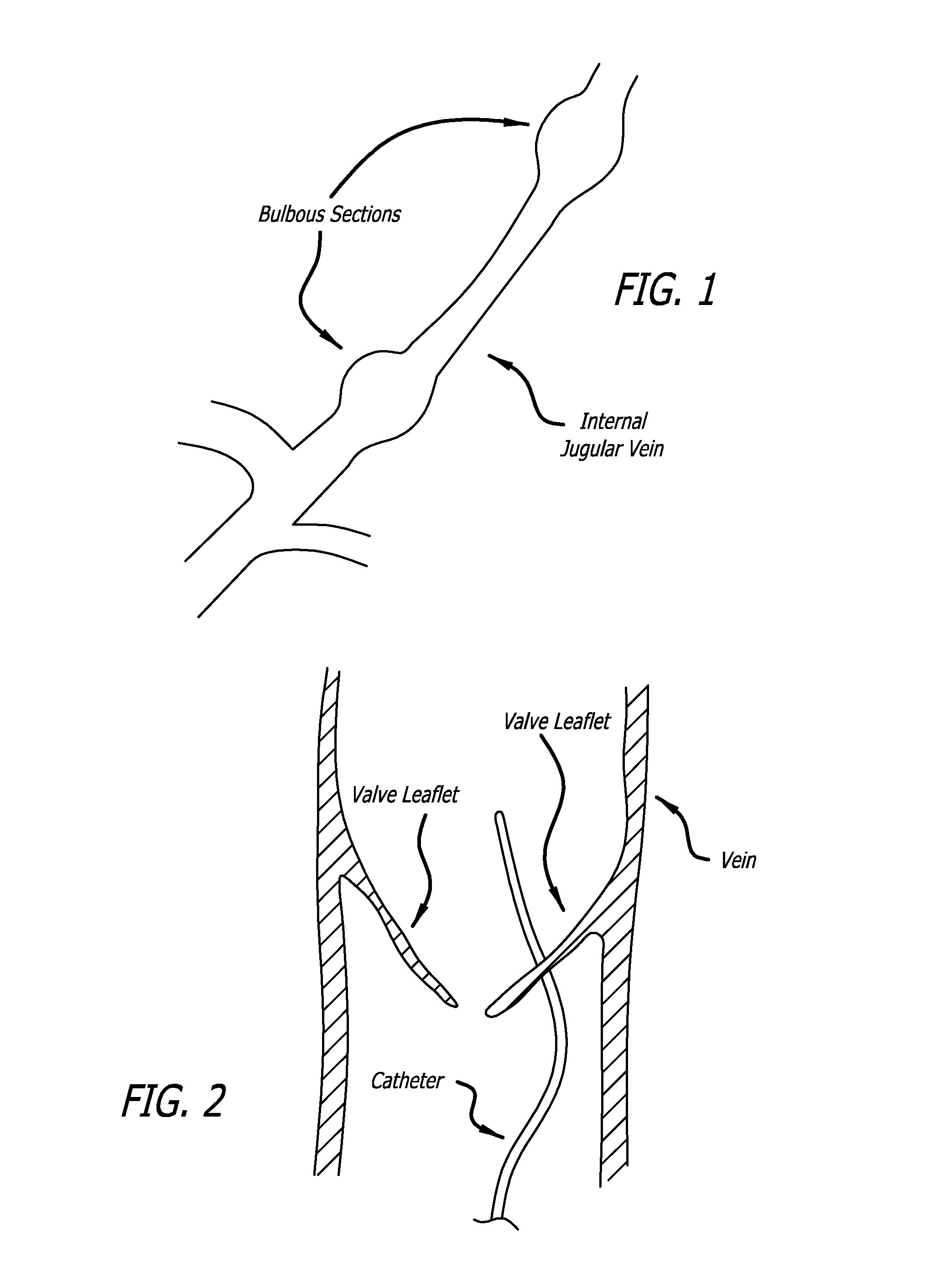 Intraluminal scaffold having an enlarged portion