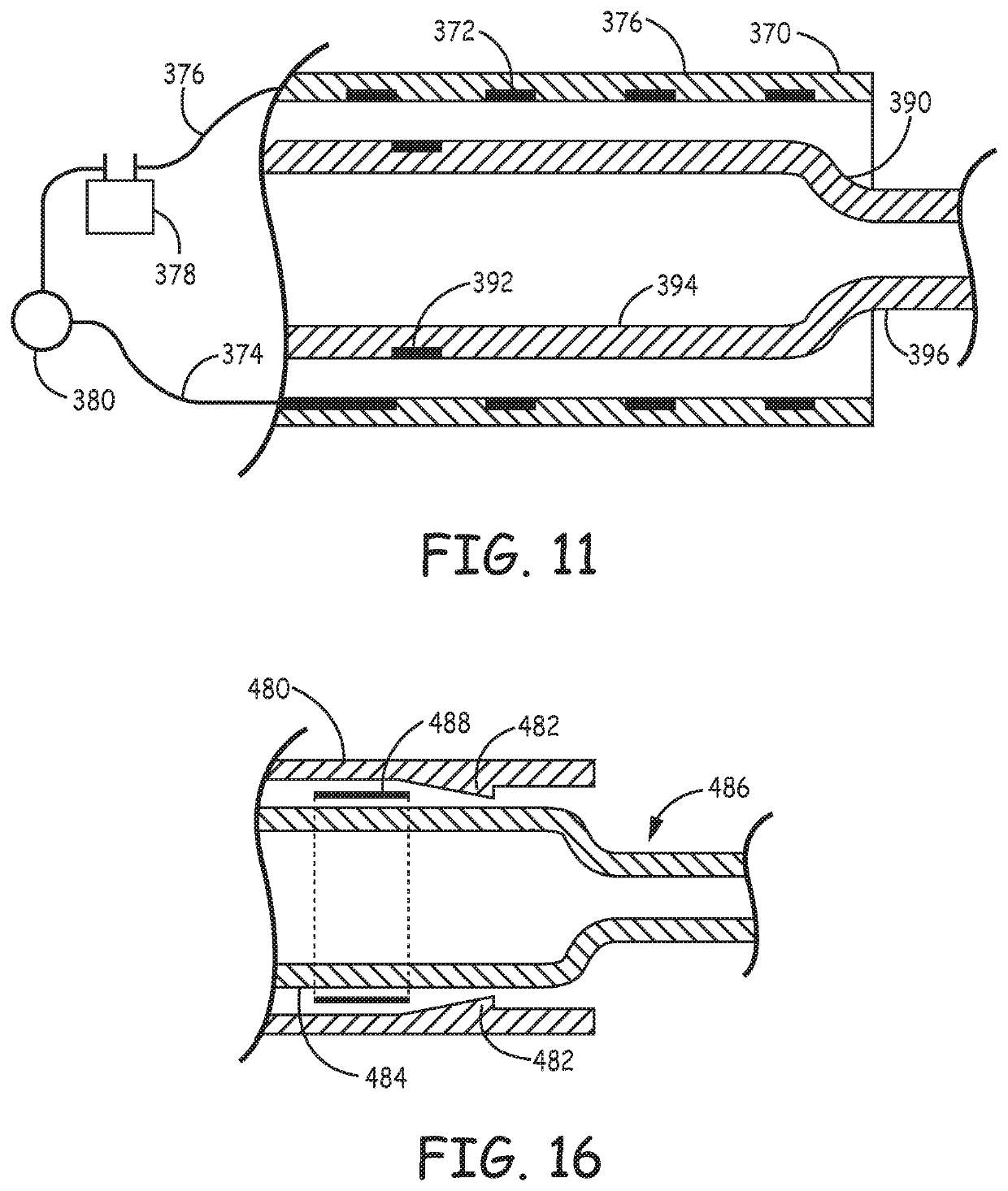 Catheter systems for applying effective suction in remote vessels and thrombectomy procedures facilitated by catheter systems