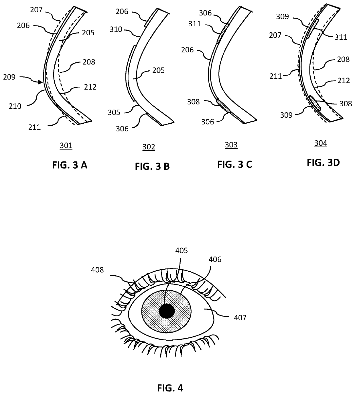 Method for the amelioration of ectatic and irregular corneal disorders