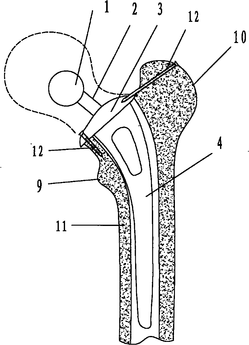 Artificial femoral prosthesis capable of preventing postoperative loosening