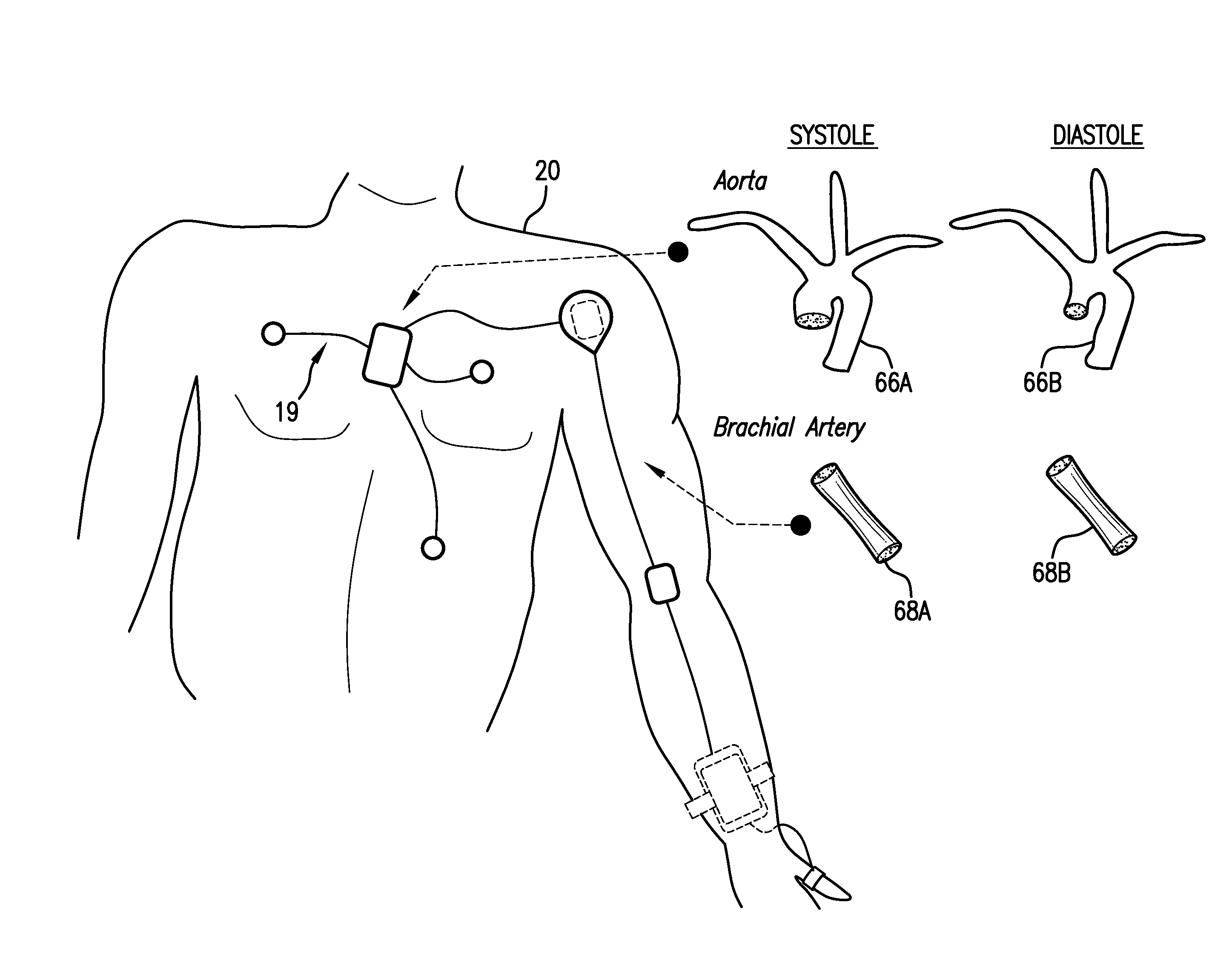 Body-worn system for continuous, noninvasive measurement of cardiac output, stroke volume, cardiac power, and blood pressure