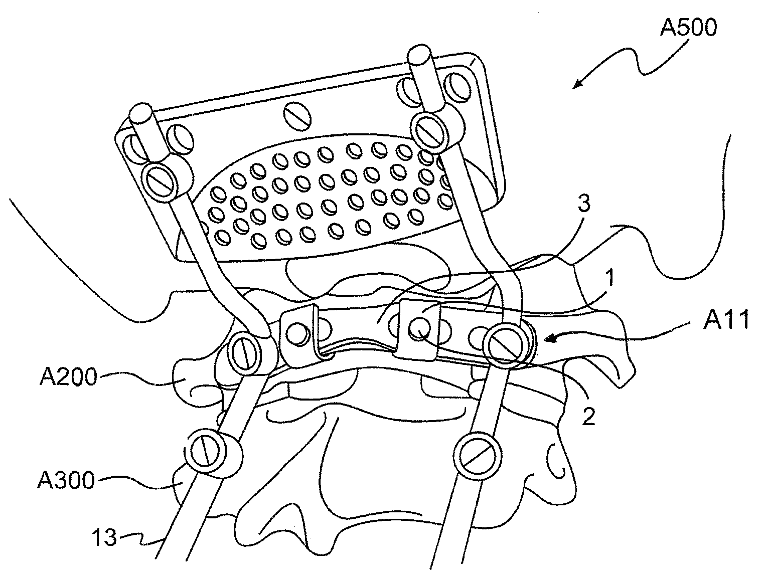 Vertebra attachment method and system