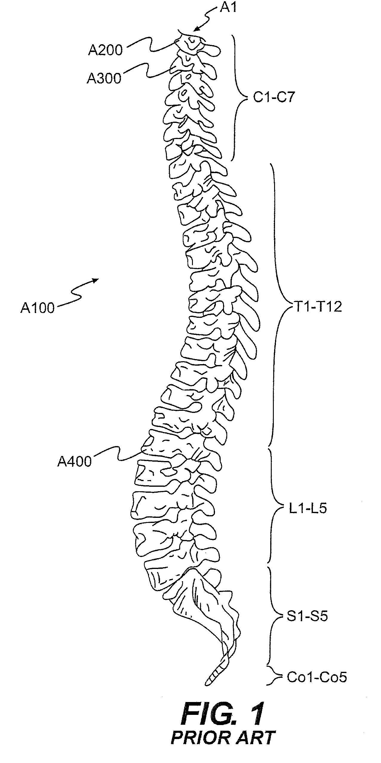 Vertebra attachment method and system