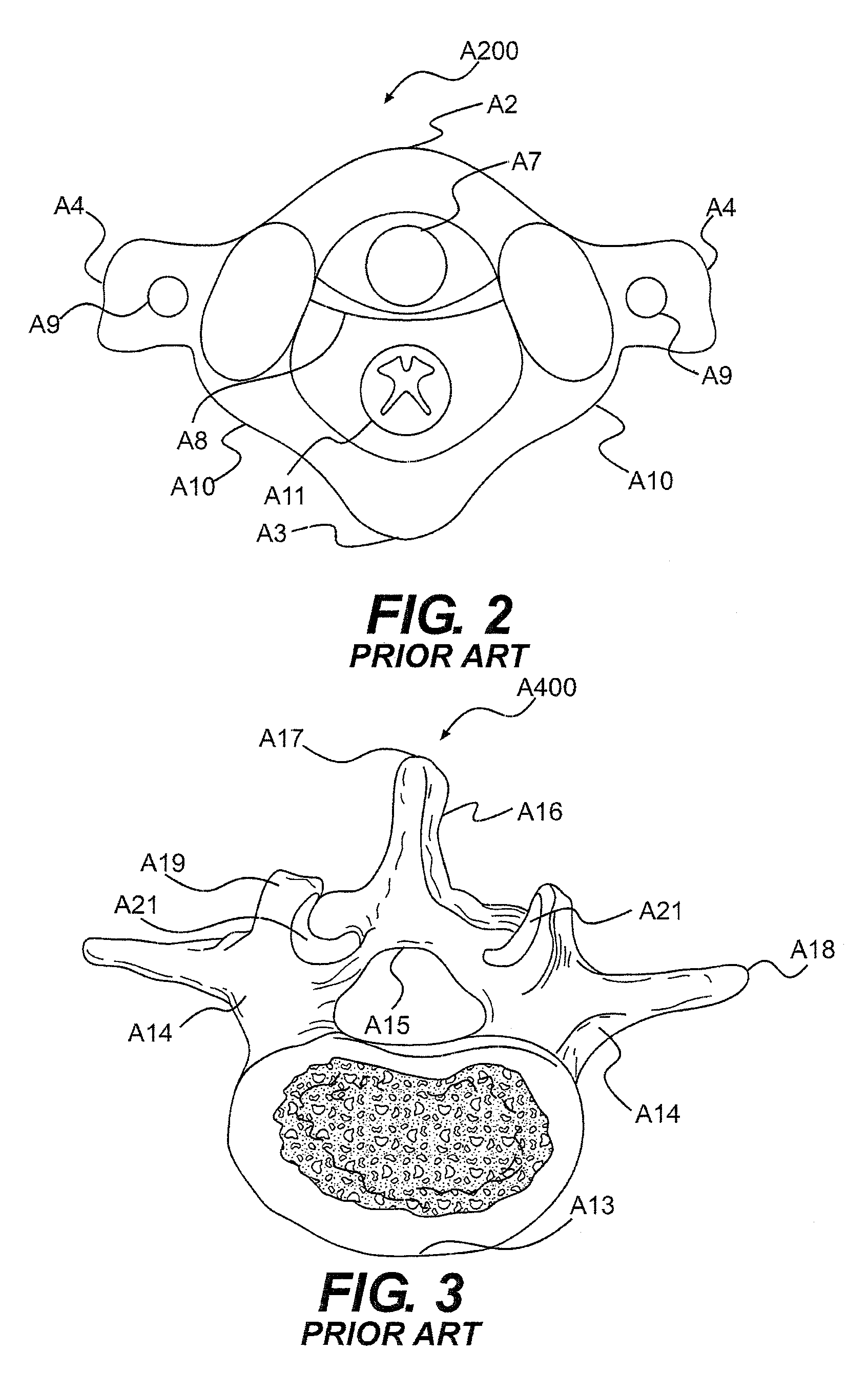 Vertebra attachment method and system