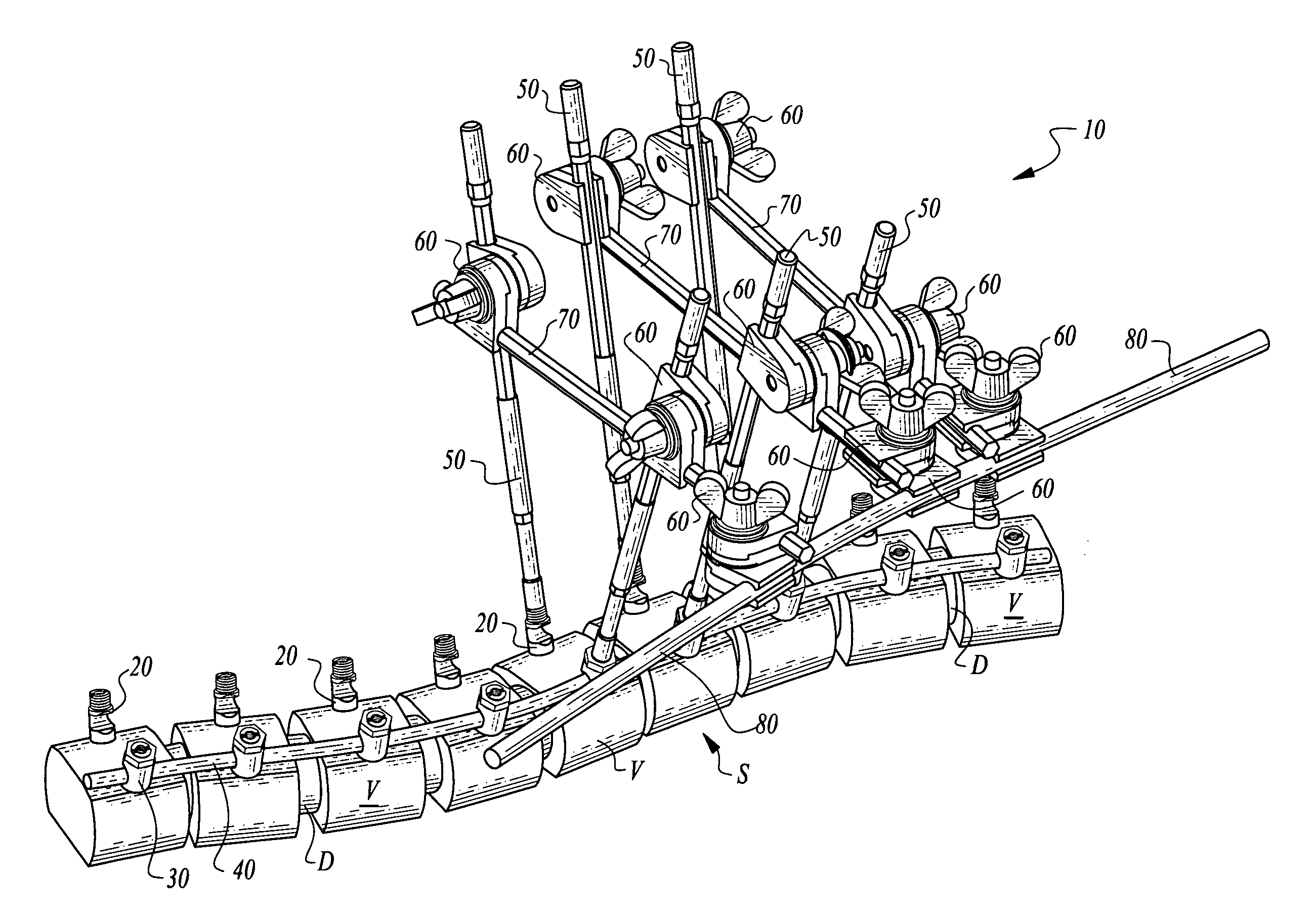 Scoliosis de-rotation system and method