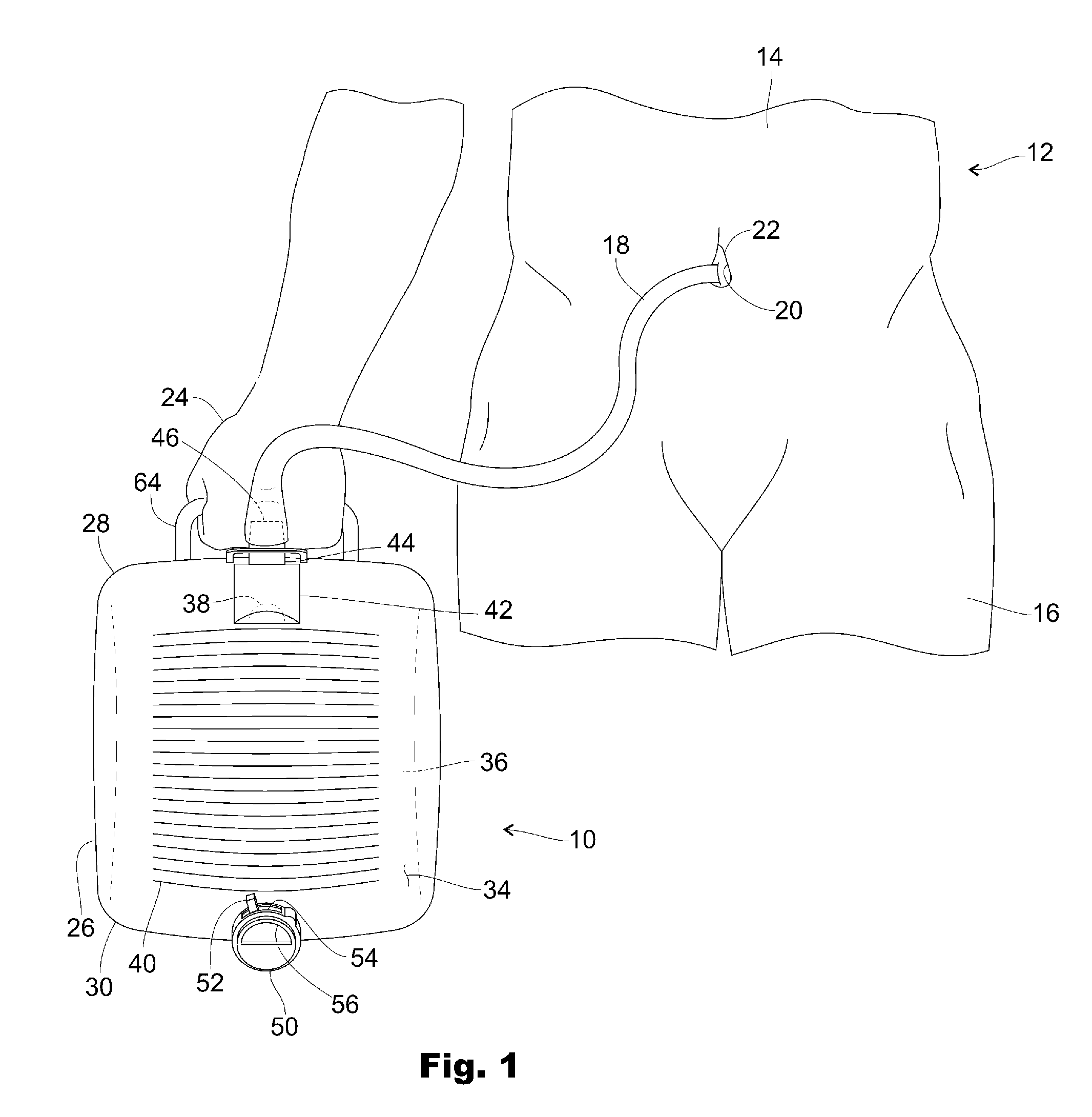 Urinary Drainage Bag for Urinary Diversion to the Bellie Button