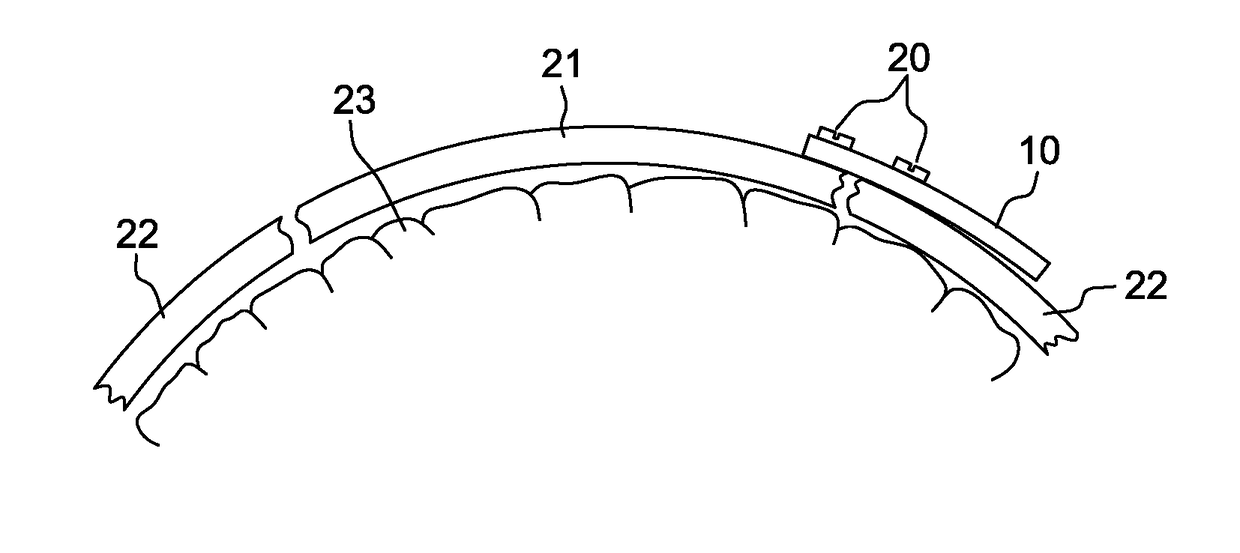 Dynamic decompressive craniotomy fixation devices and related methods