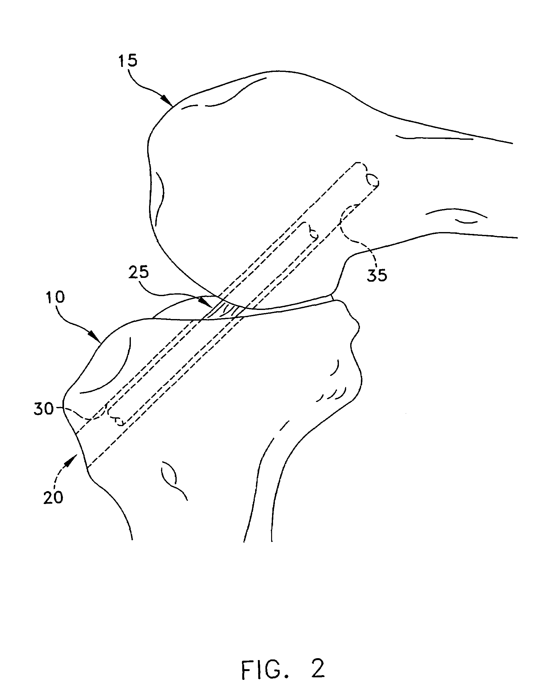 Apparatus and method for reconstructing a ligament