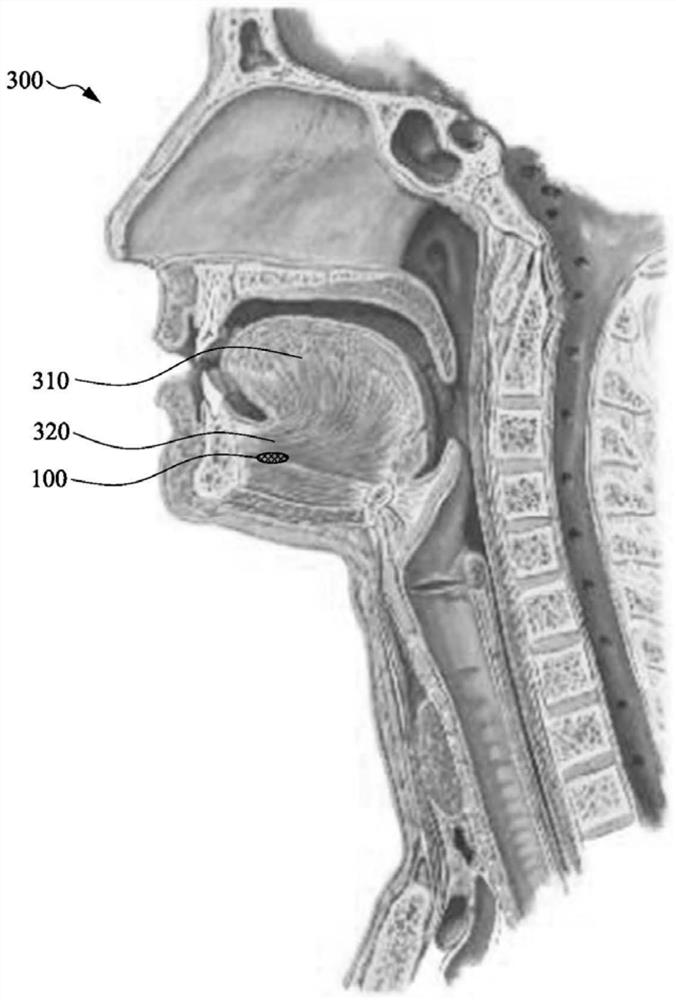 Sleep apnea treatment device