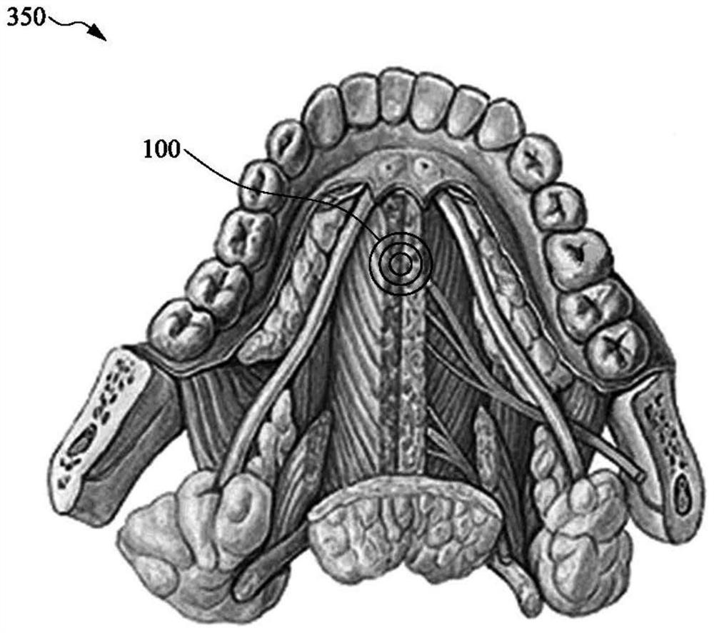 Sleep apnea treatment device