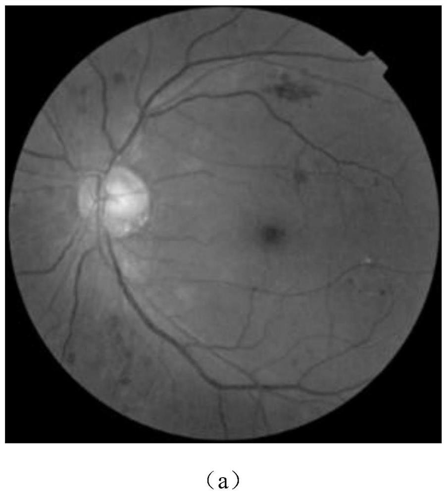 A classification method for diabetic retinopathy based on multi-scale cascade