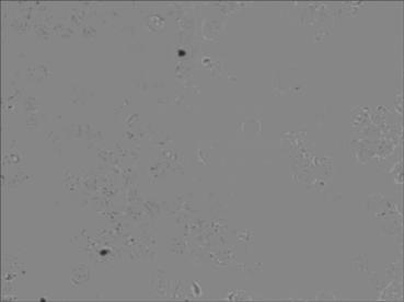 Kit for mRNA level in-site hybridization detection in leukemia precursor lesion, and detecting method and application thereof