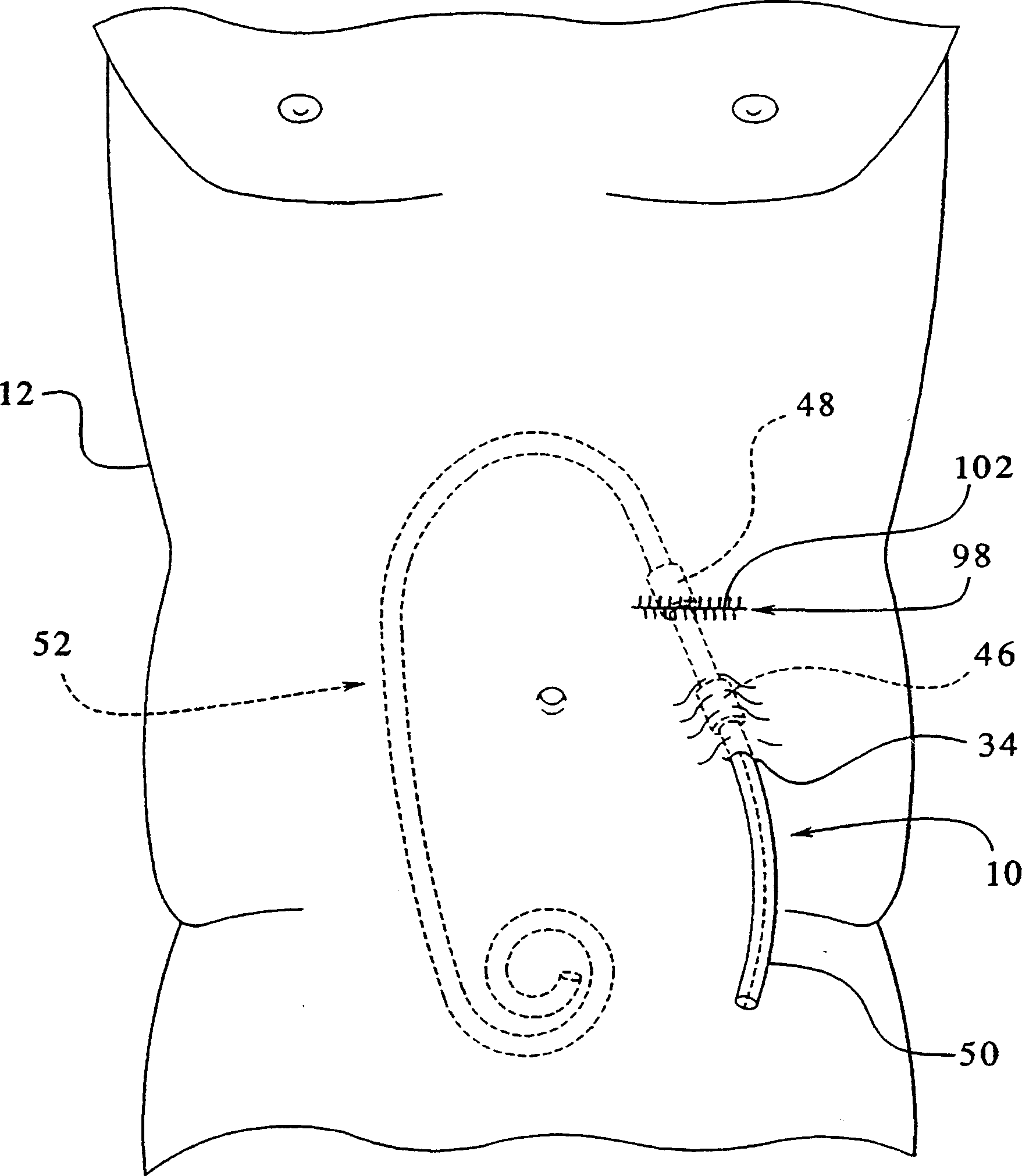 Peritoneal dialysis catheters