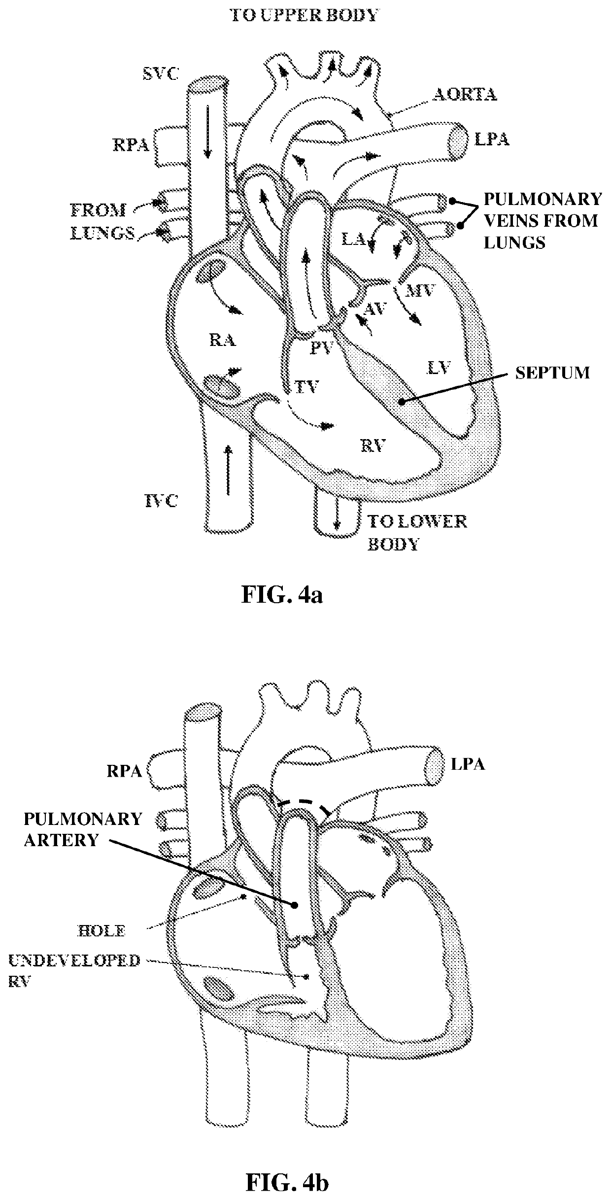 Implantable cardio-vascular flow streamliner