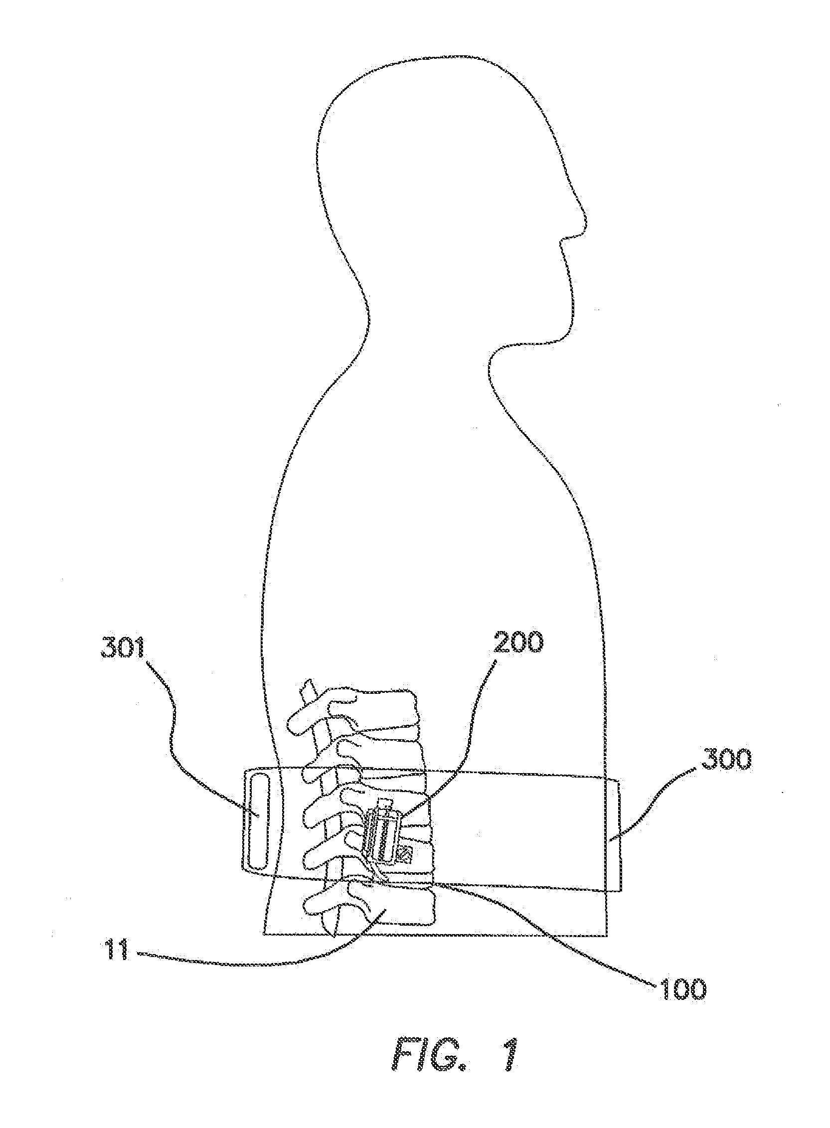 Remotely Activated Piezoelectric Pump for Delivery of Biological Agents to the Intervertebral Disc and Spine