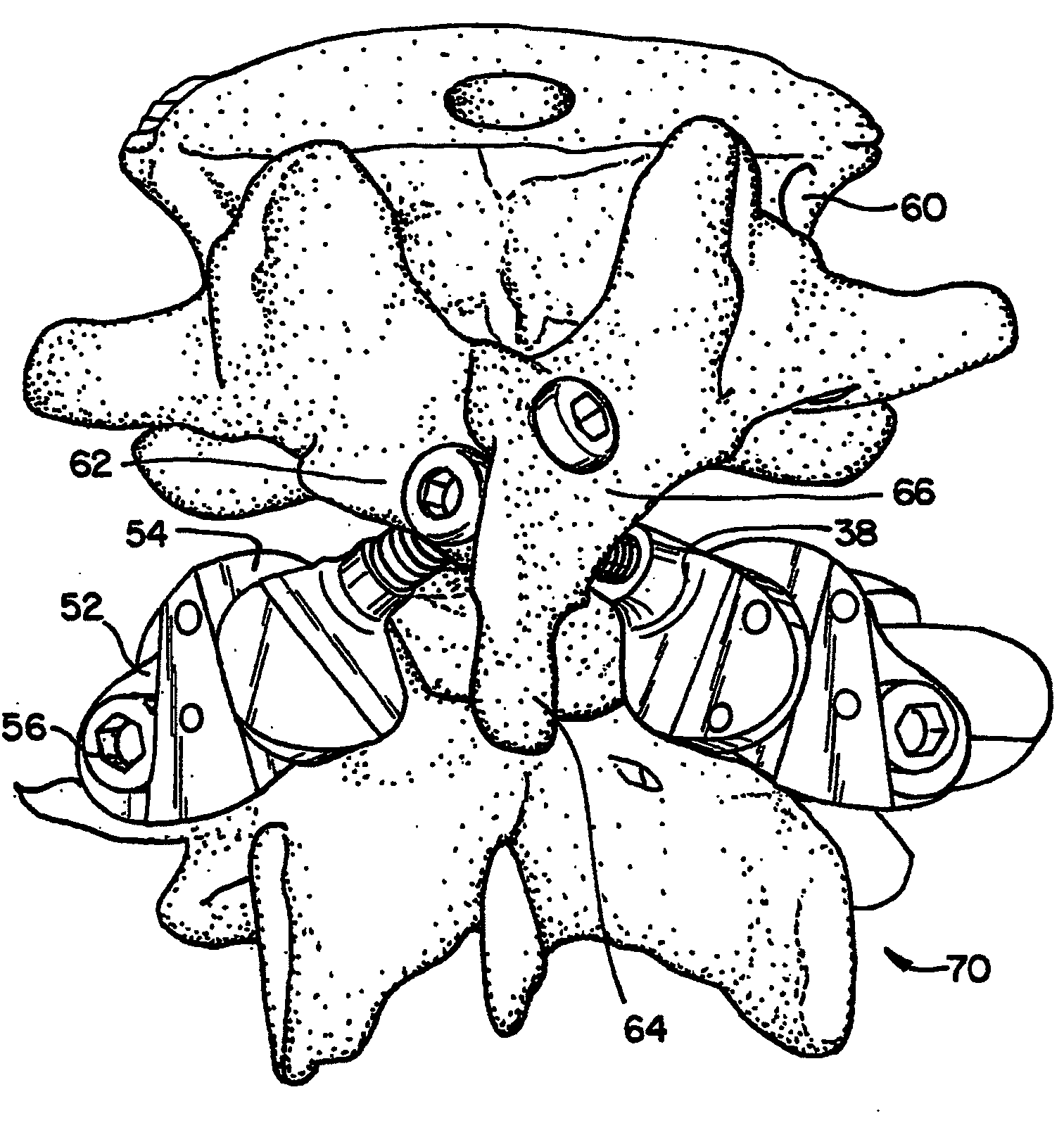 Prostheses, tools and methods for replacement of natural facet joints with artificial facet joint surfaces