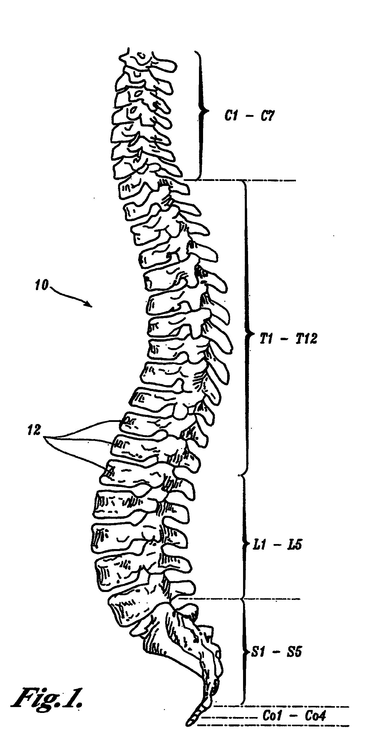 Prostheses, tools and methods for replacement of natural facet joints with artificial facet joint surfaces