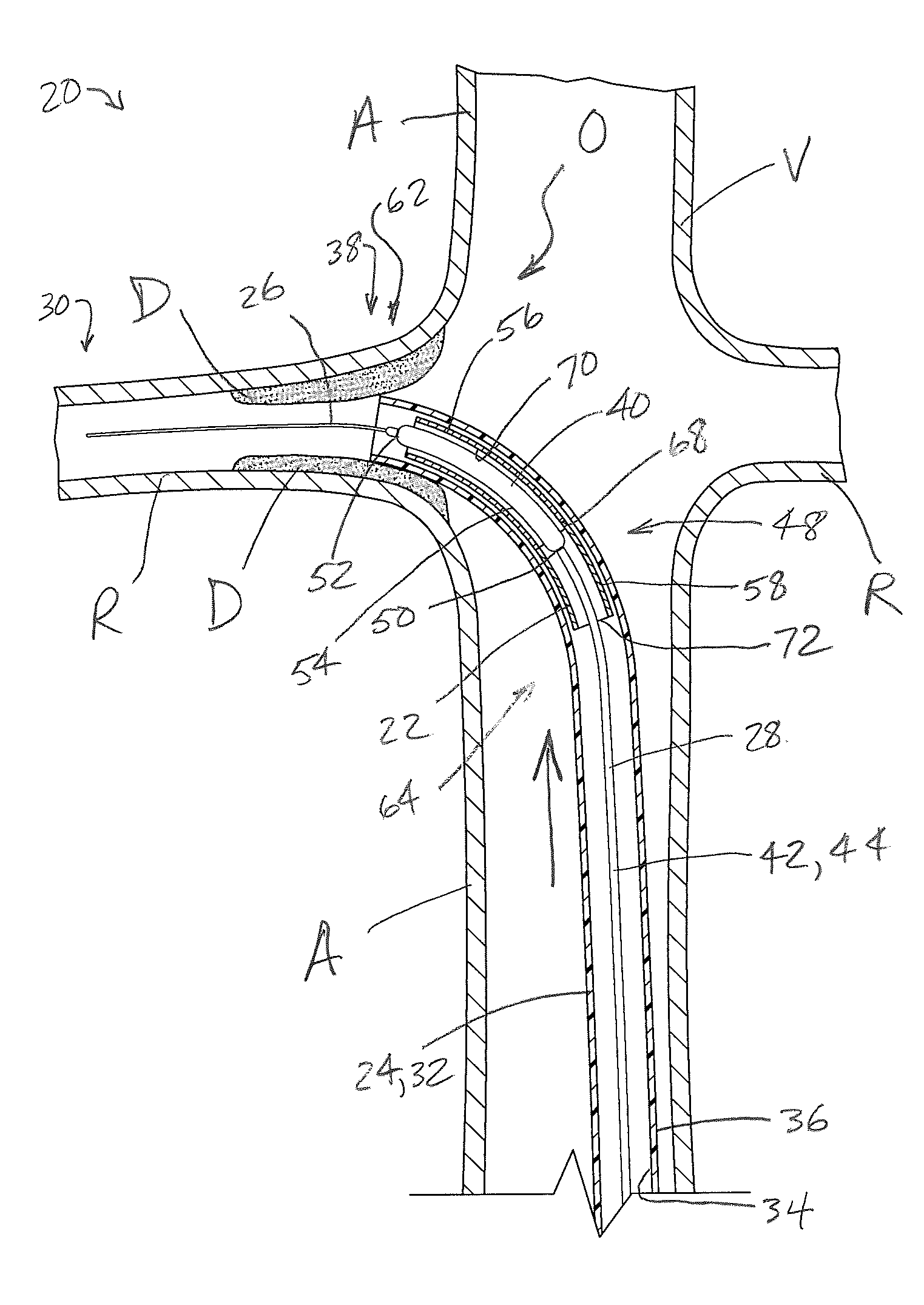 Ostial stent