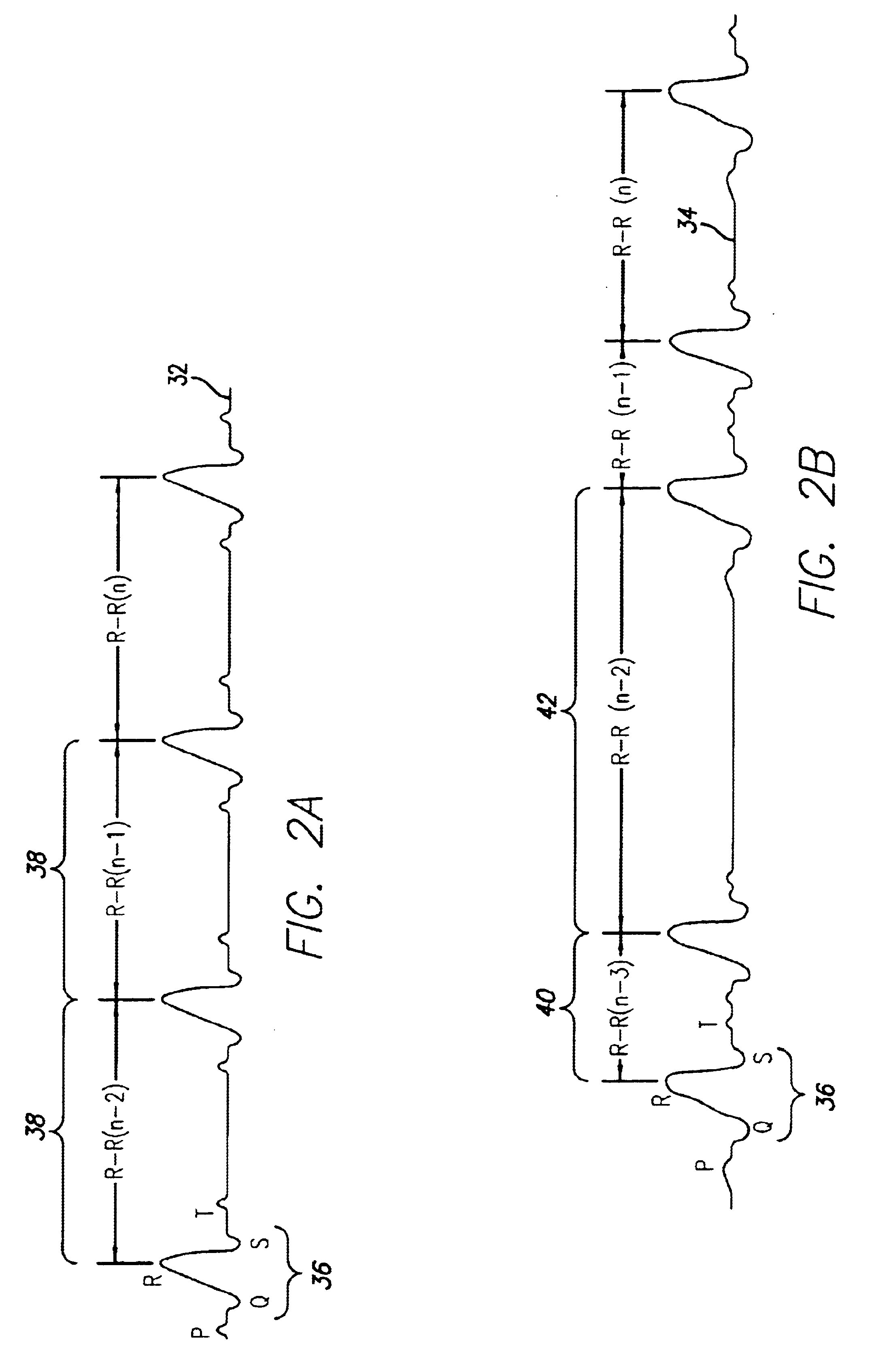 Portable ECG monitor and method for atrial fibrillation detection