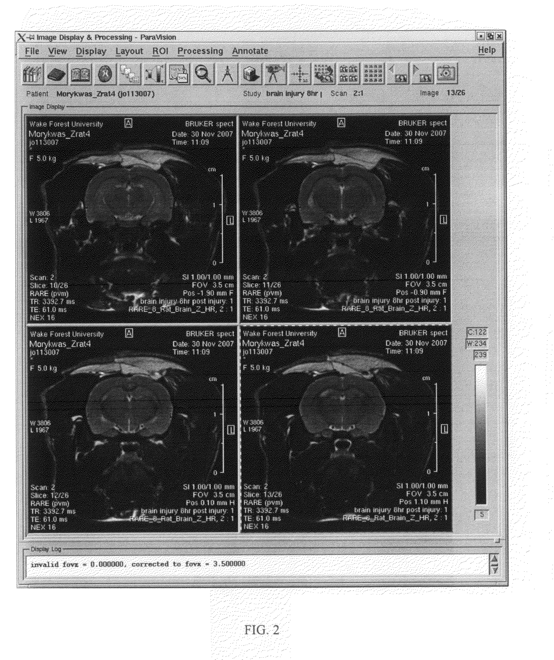 Device and method for treating central nervous system pathology