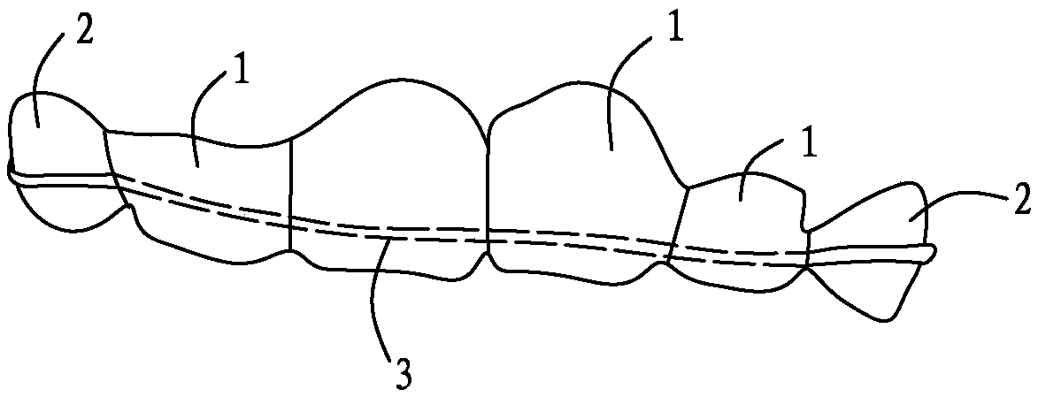 Deciduous dentition anterior tooth zone missing space maintainer