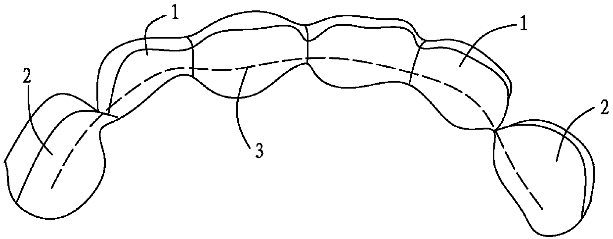 Deciduous dentition anterior tooth zone missing space maintainer