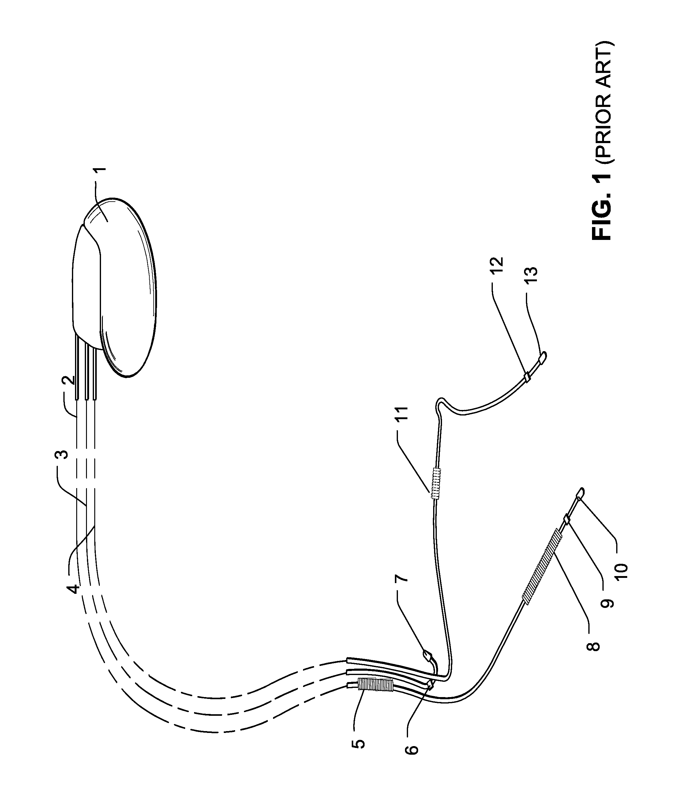 Apparatus and method for detection of lead failure in an implantable medical device