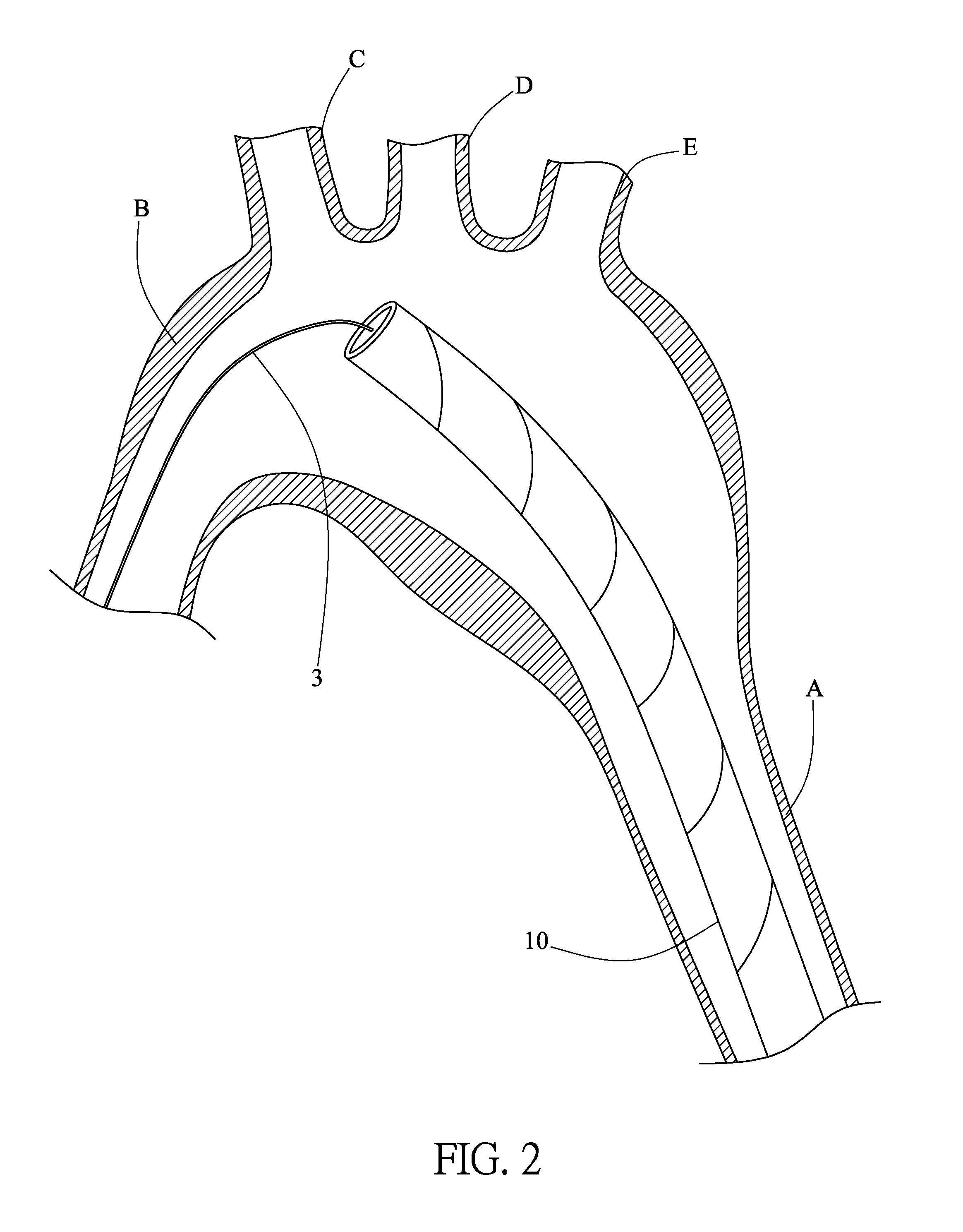 Method of implanting an aortic stent