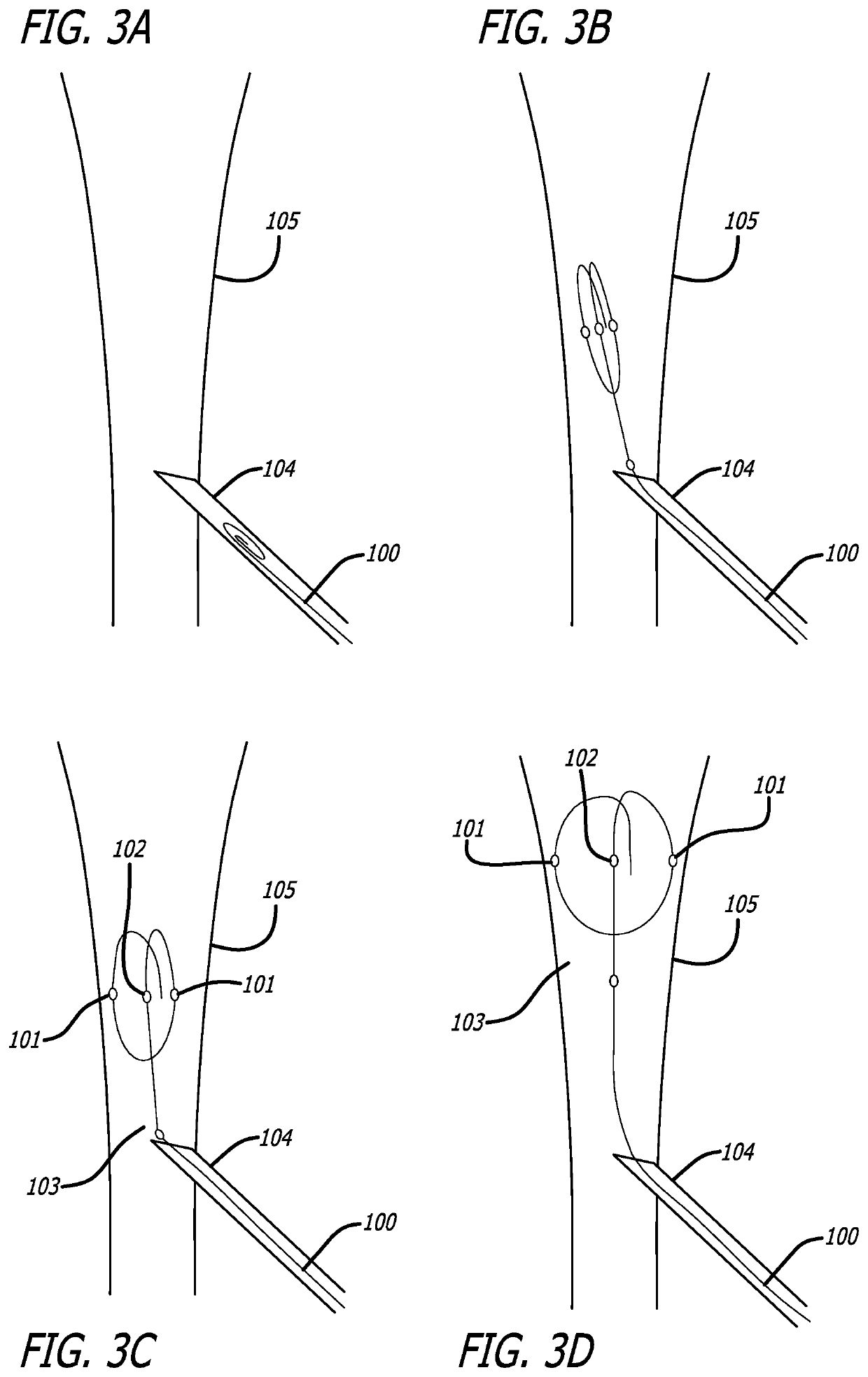 Devices And Methods For Guide Wire Placement