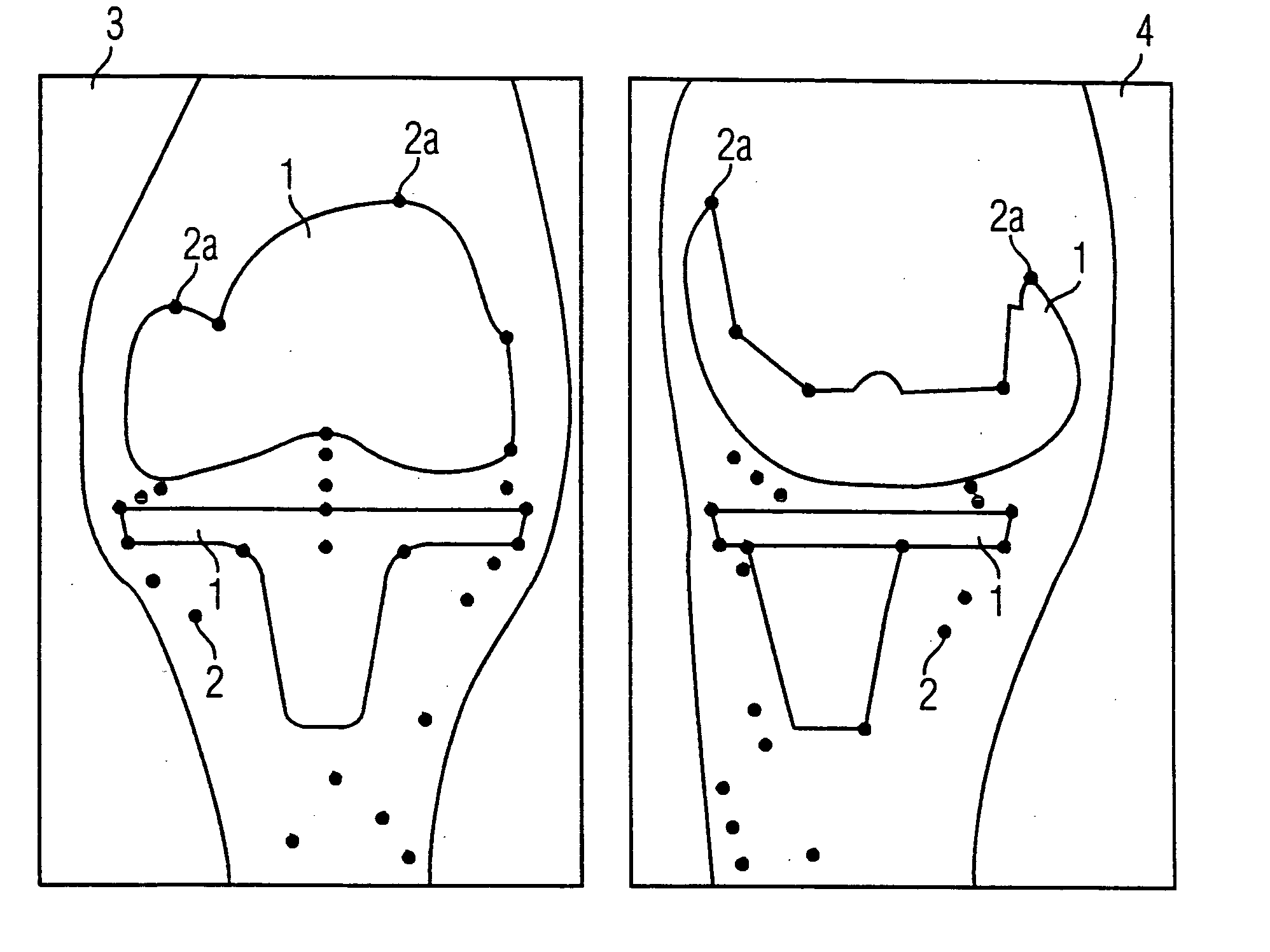 Method and x-ray system for detecting position changes of a medical implant