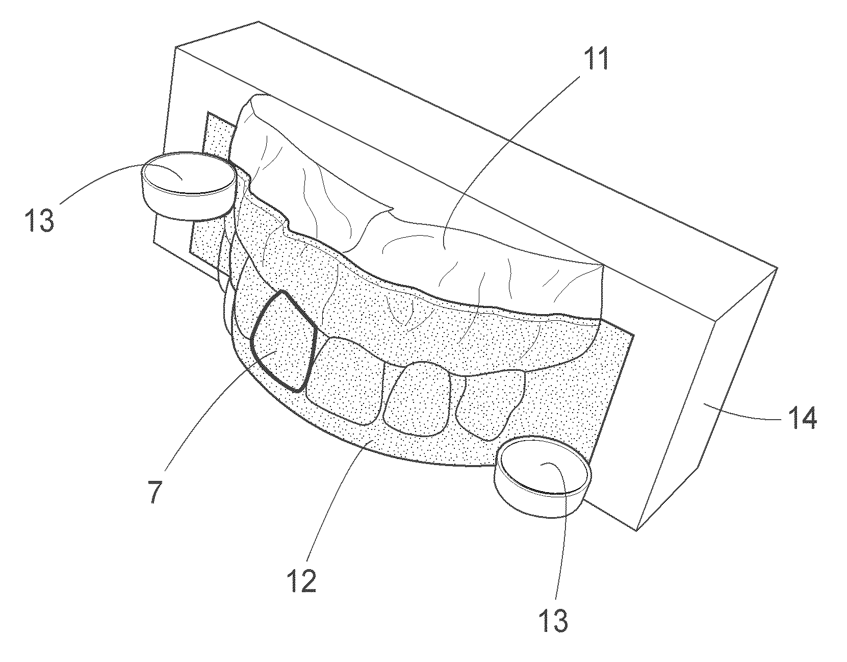 Dental product comprising at least one veneer