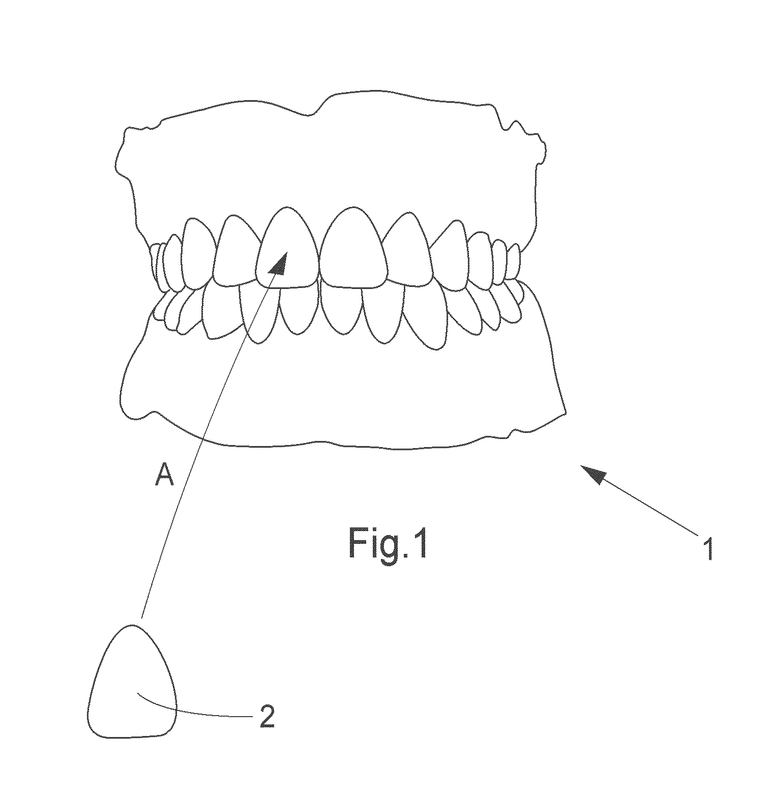 Dental product comprising at least one veneer