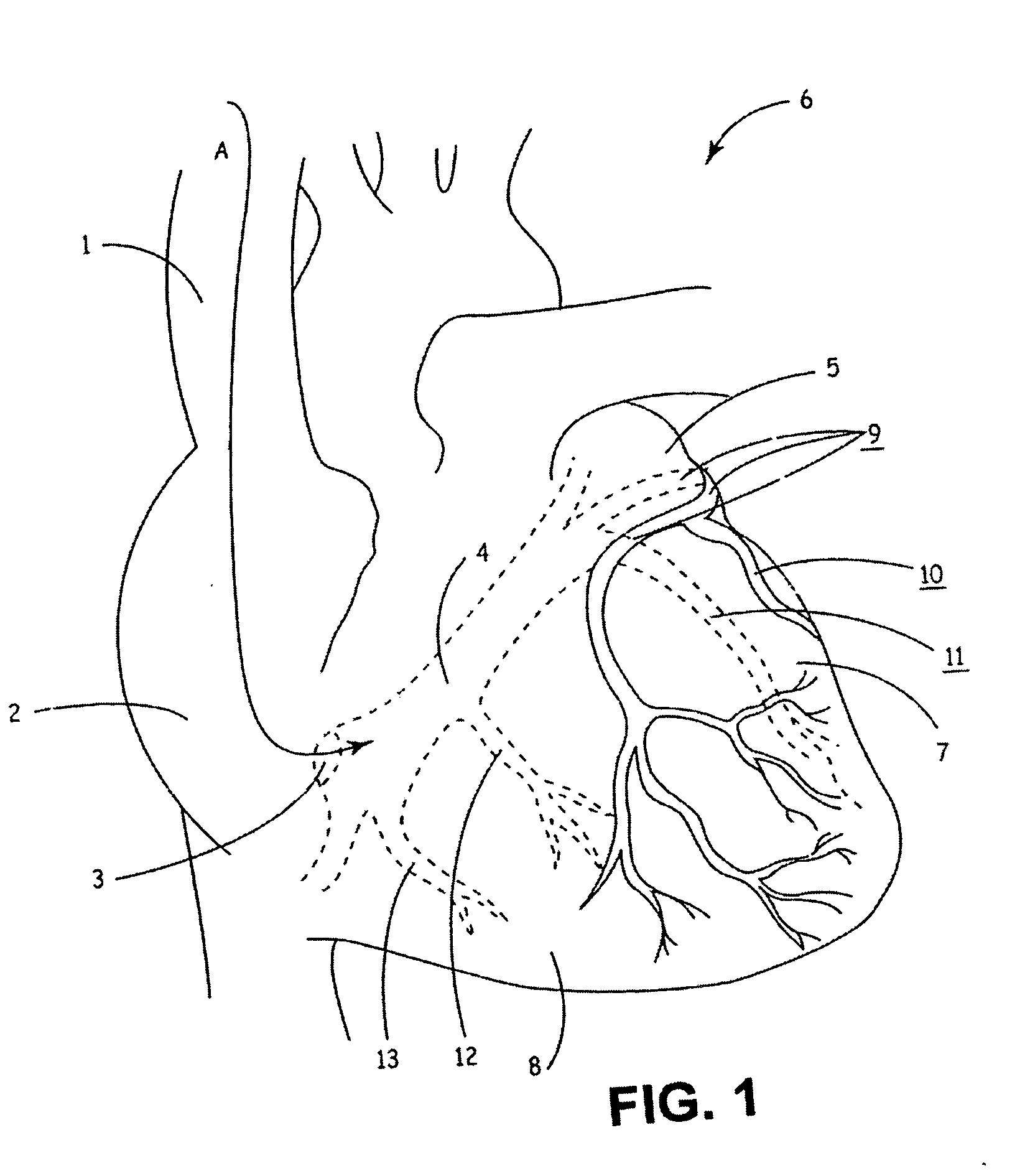 Guide catheters for accessing cardiac sites