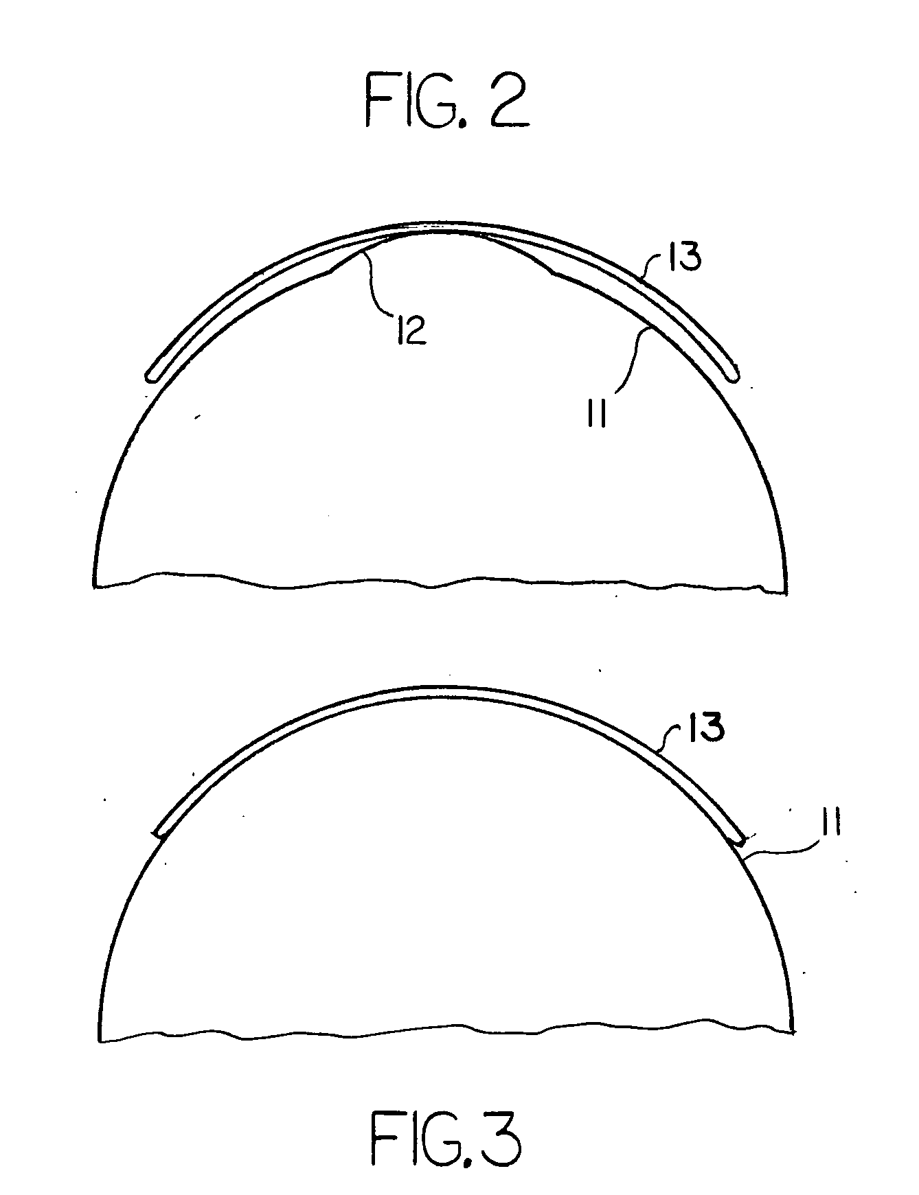 Method of improving vision using contact lenses and corneal collagen crosslinking