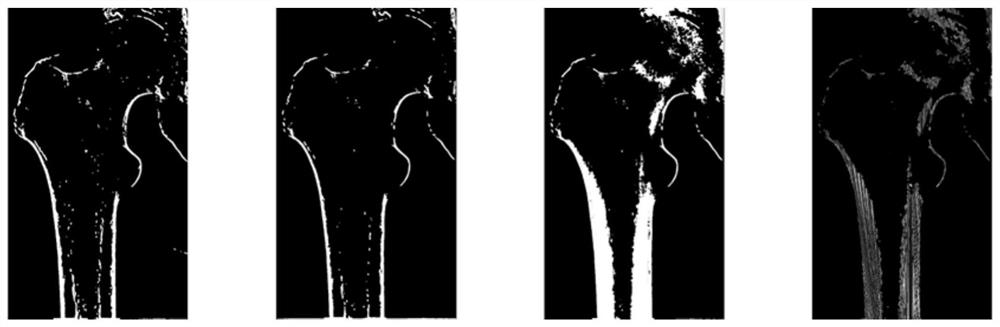 Femoral marrow cavity type detection method and system