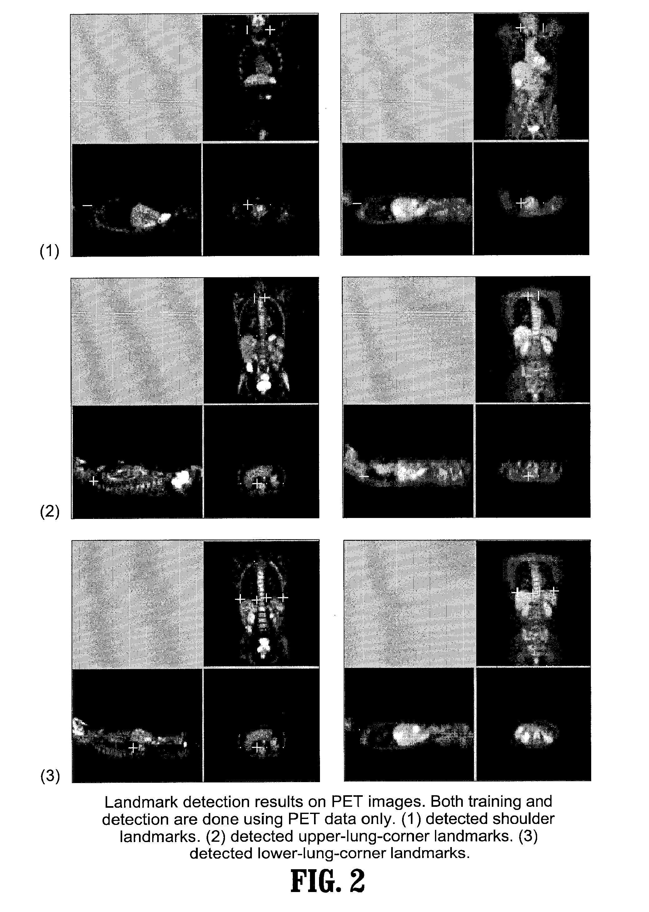 System and method for whole body landmark detection, segmentation and change quantification in digital images