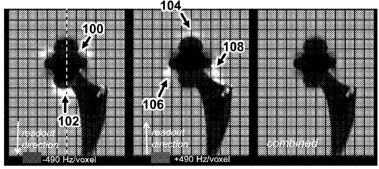 Alternating Gradients for Metal-Induced Artifacts Correction in Magnetic Resonance Imaging